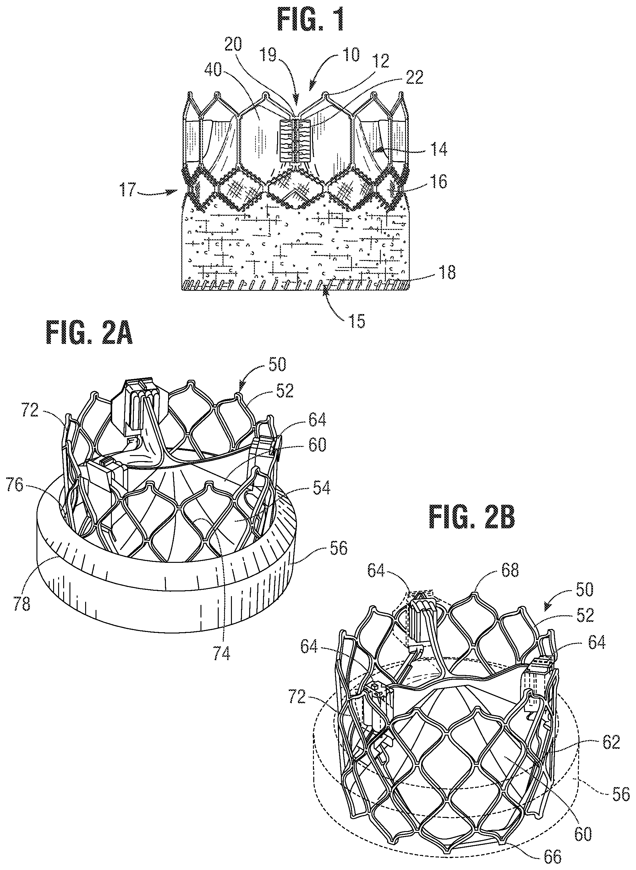 Patent US12564491 Figure 1 – Multi-layer covering for a prosthetic heart valve