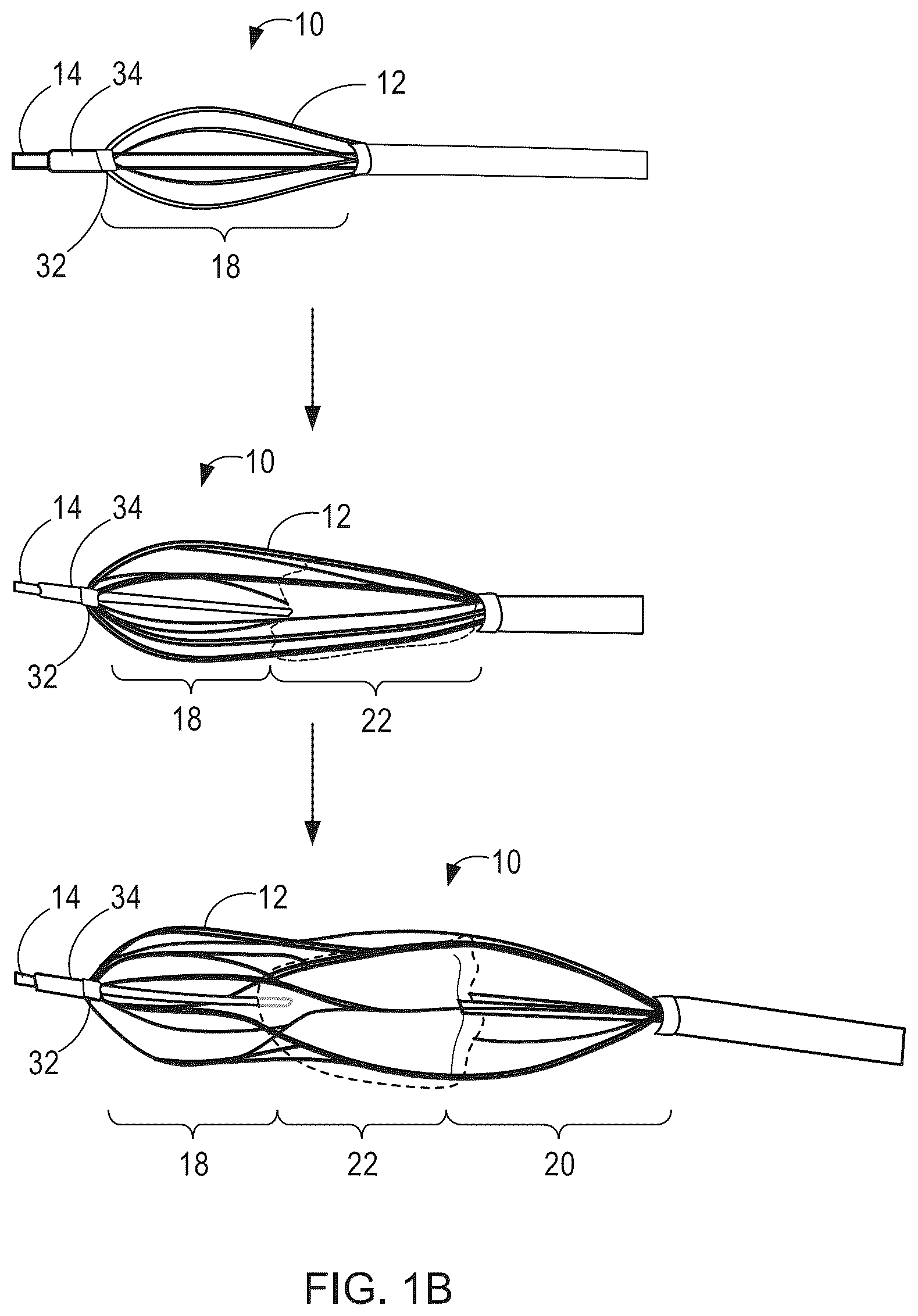 Patent US12564492 Figure 2 – Retrievable self-expanding non-thrombogenic low-profile percutaneous atrioventricular valve prosthesis