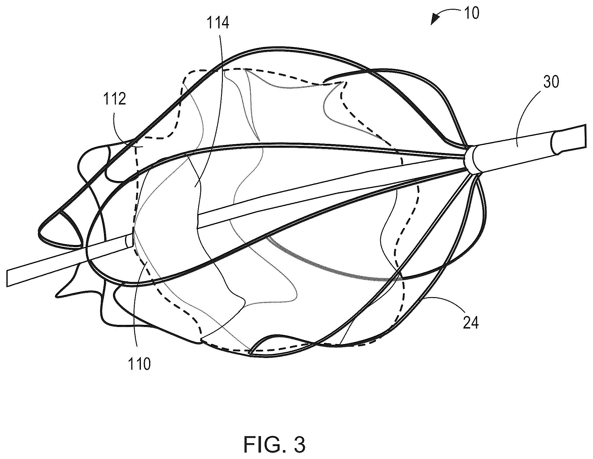 Patent US12564492 Figure 4 – Retrievable self-expanding non-thrombogenic low-profile percutaneous atrioventricular valve prosthesis