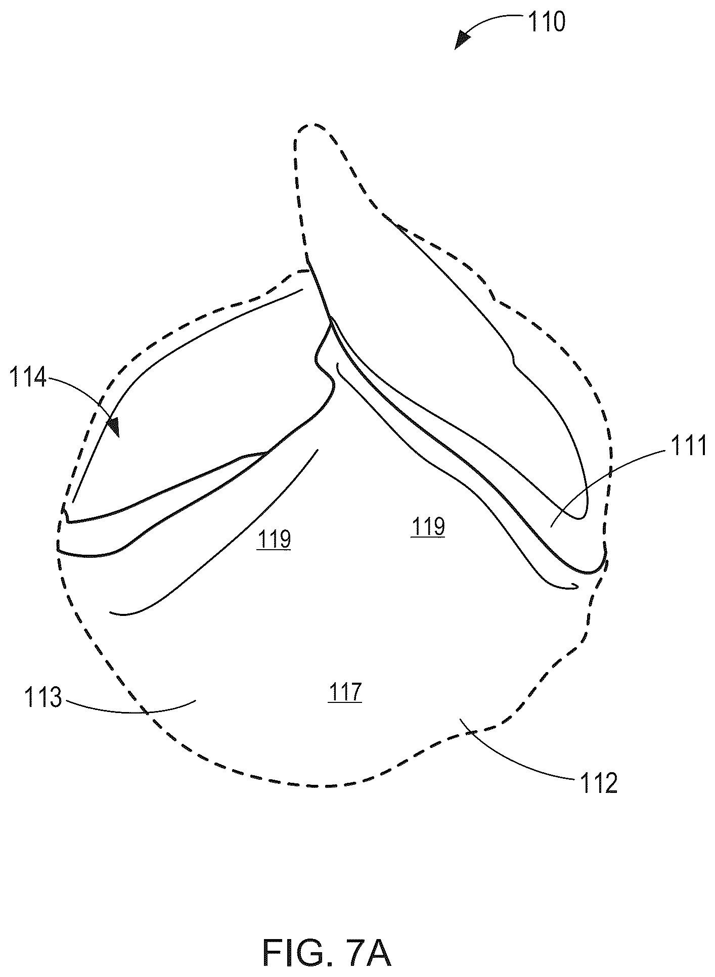Patent US12564492 Figure 10 – Retrievable self-expanding non-thrombogenic low-profile percutaneous atrioventricular valve prosthesis