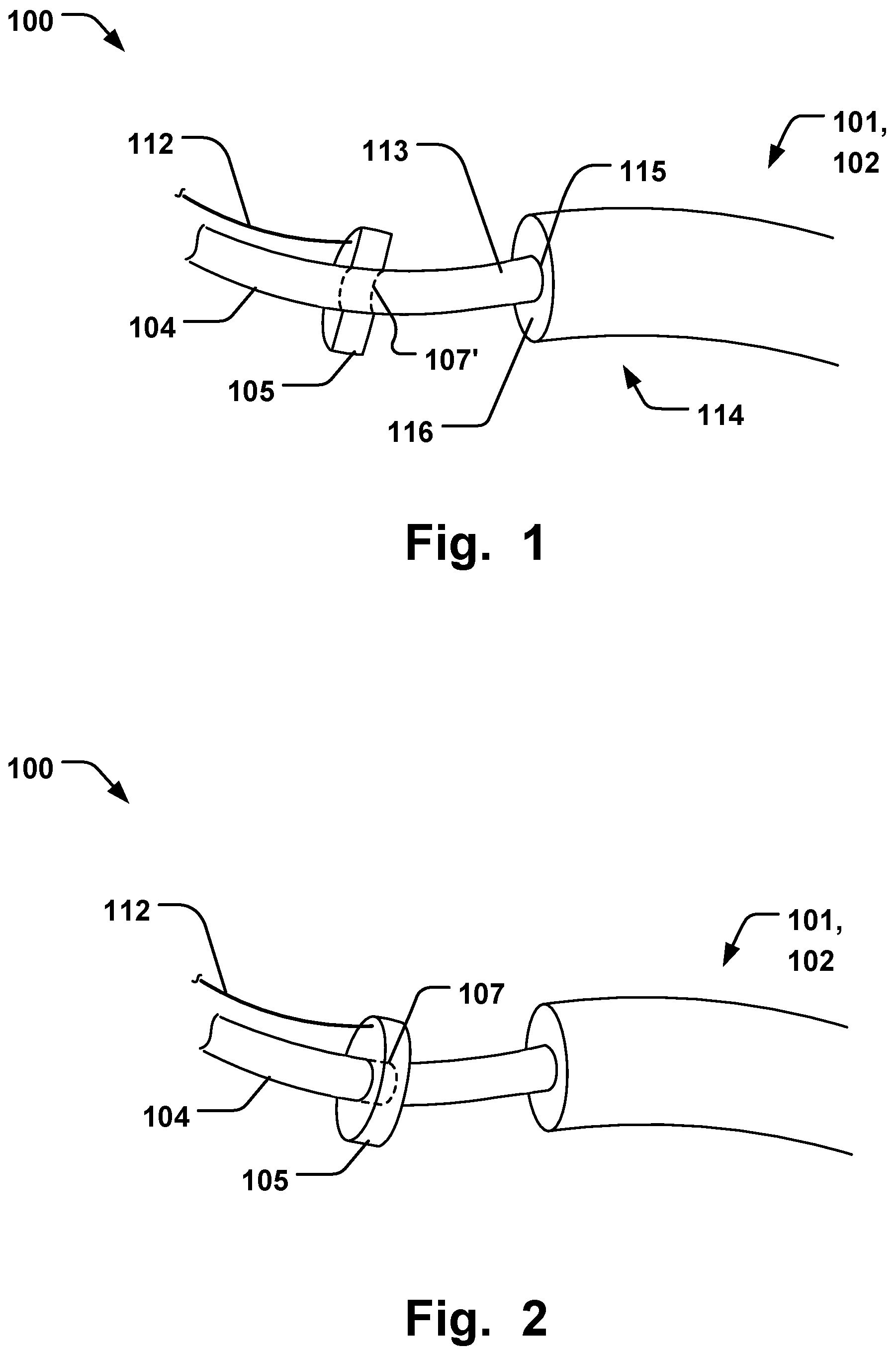Patent US12564493 — Annuloplasty system — Figure 1