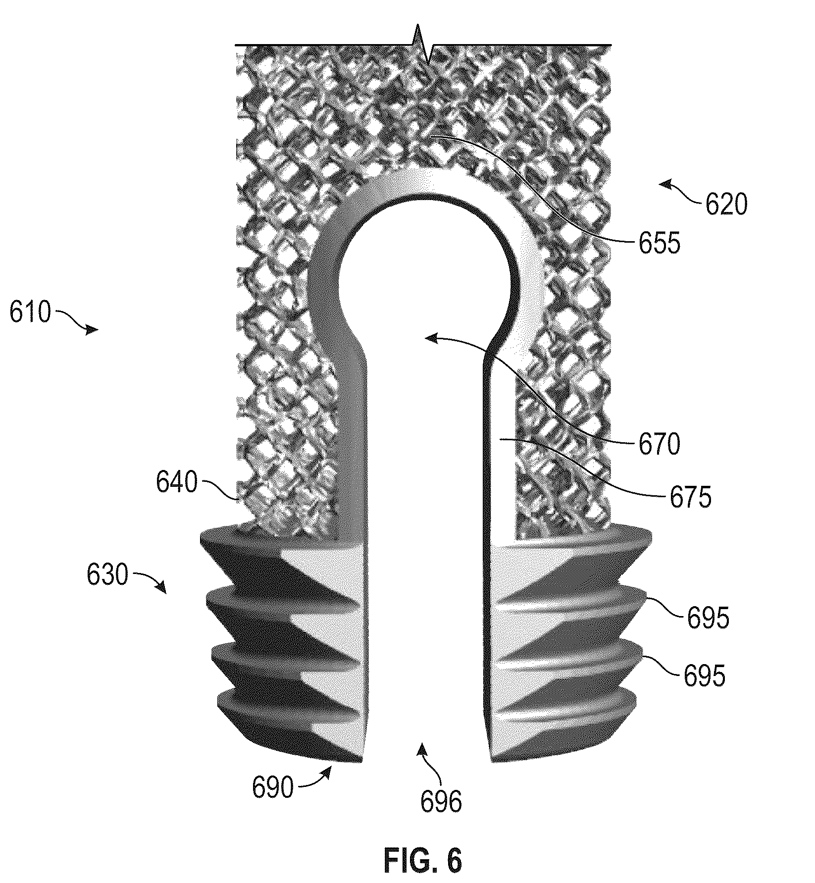 Patent US12564496 Figure 6 – Hybrid fixation features for three-dimensional porous structures for bone ingrowth and methods for producing