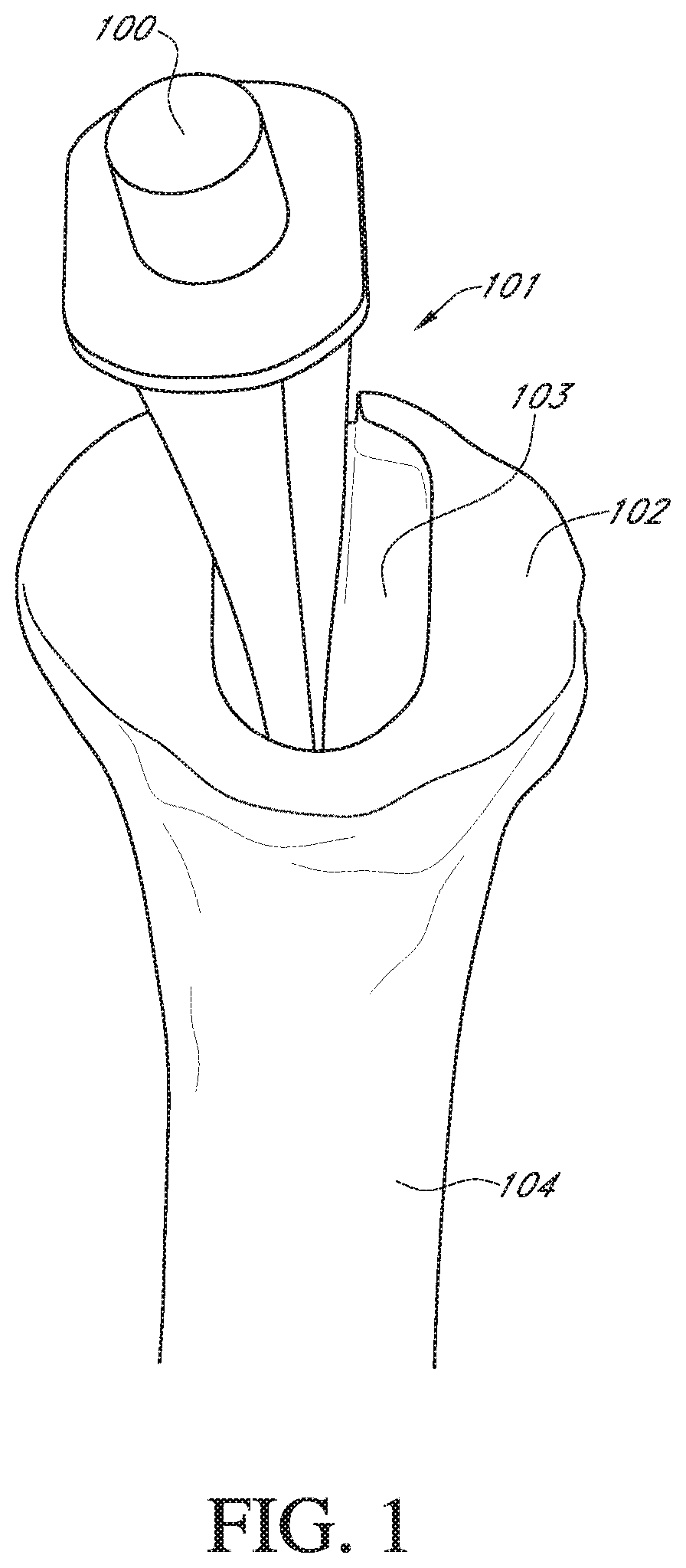 Patent US12564498 Figure 1 – Alignment guide for humeral or femoral stem replacement prostheses