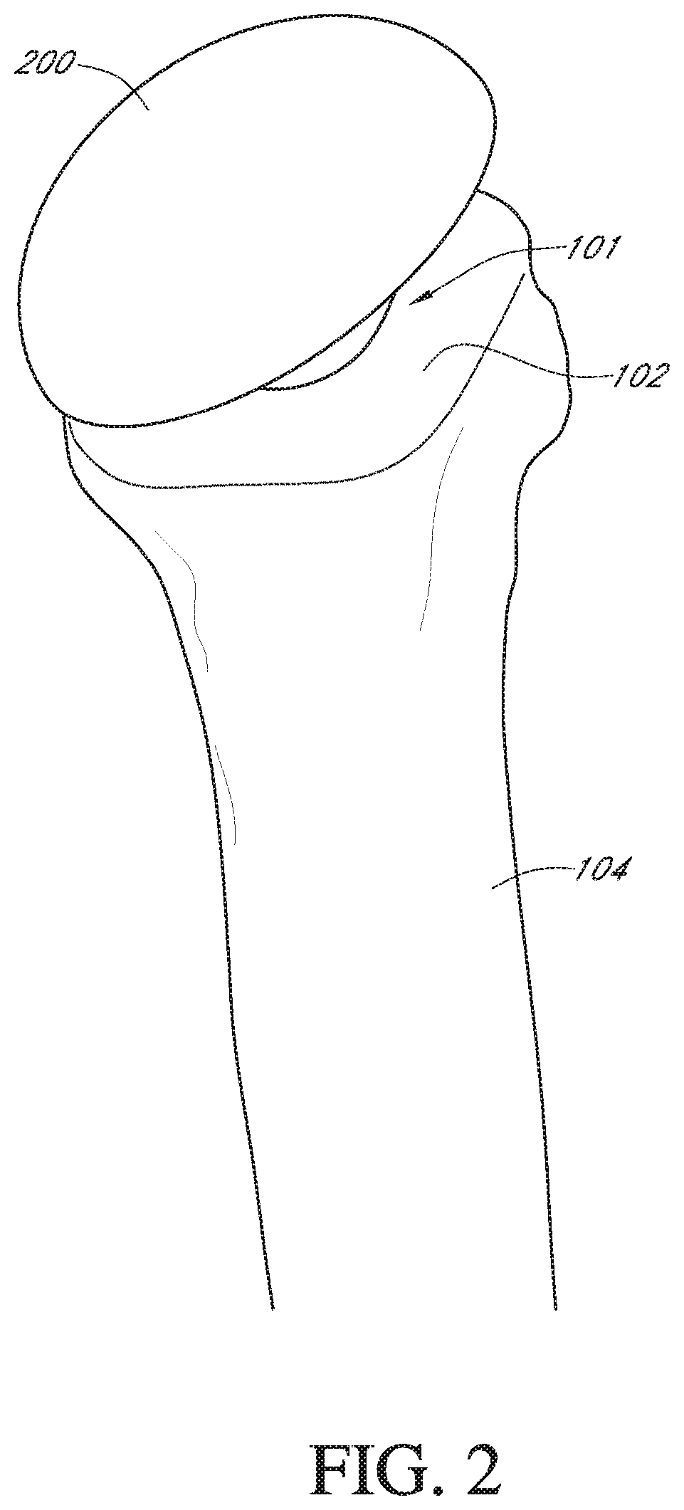 Patent US12564498 Figure 2 – Alignment guide for humeral or femoral stem replacement prostheses