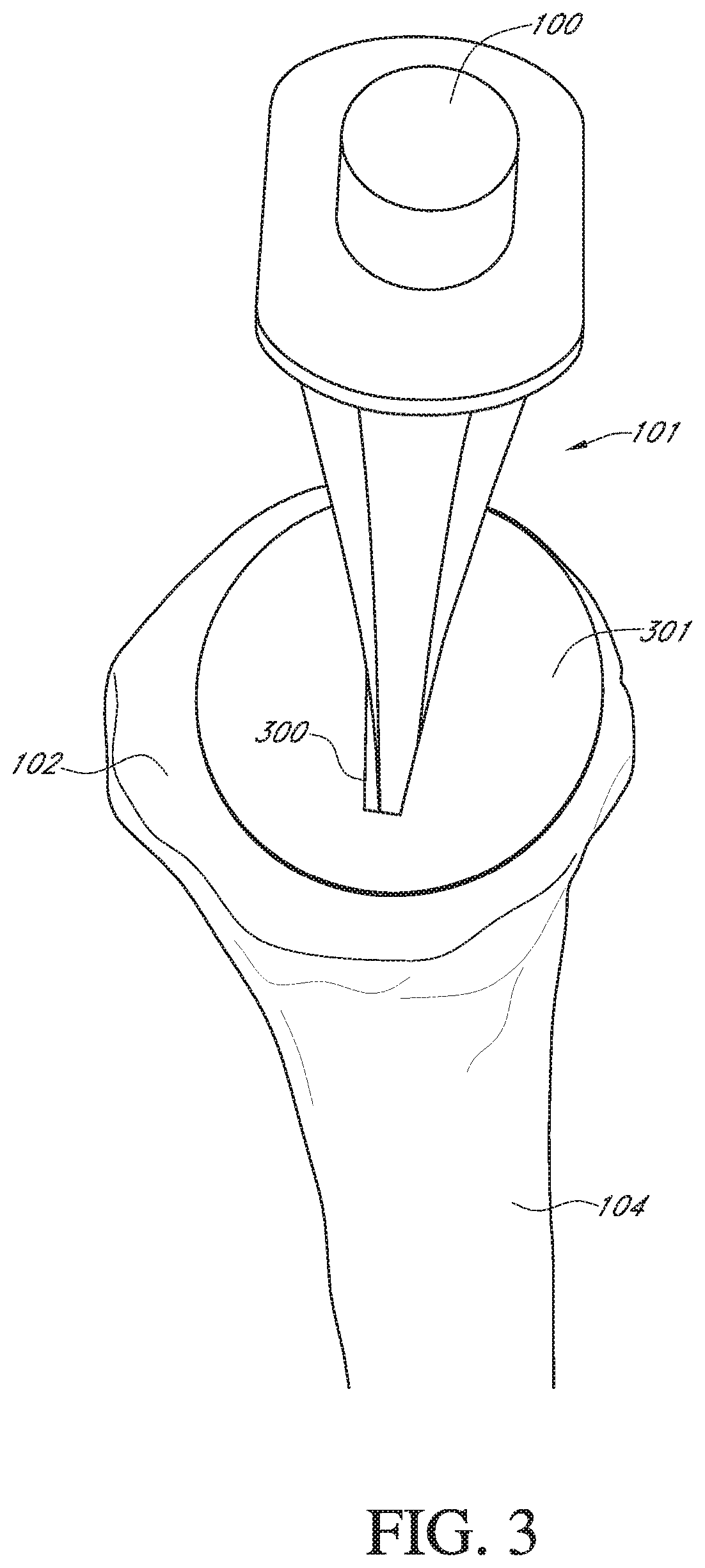 Patent US12564498 Figure 3 – Alignment guide for humeral or femoral stem replacement prostheses