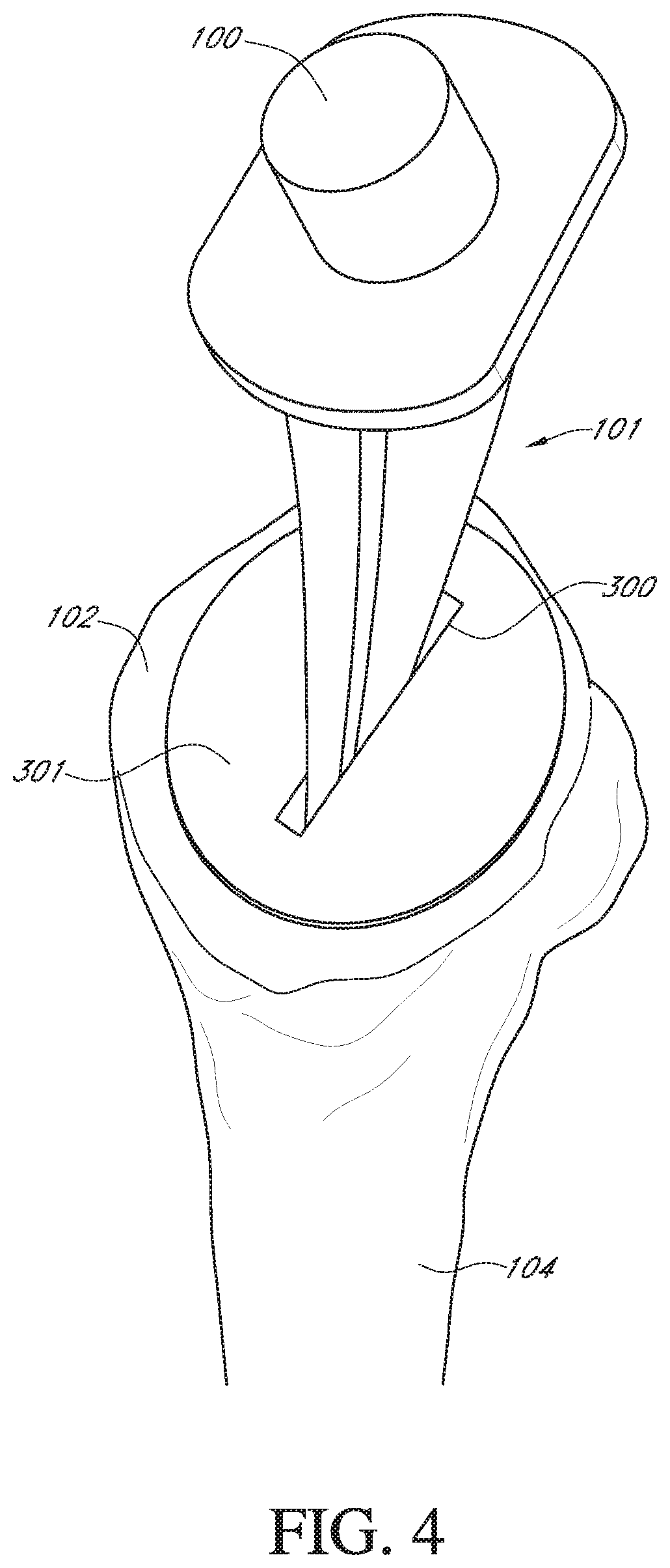 Patent US12564498 Figure 4 – Alignment guide for humeral or femoral stem replacement prostheses