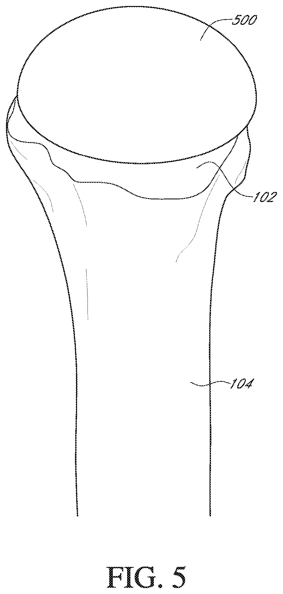 Patent US12564498 Figure 7 – Alignment guide for humeral or femoral stem replacement prostheses