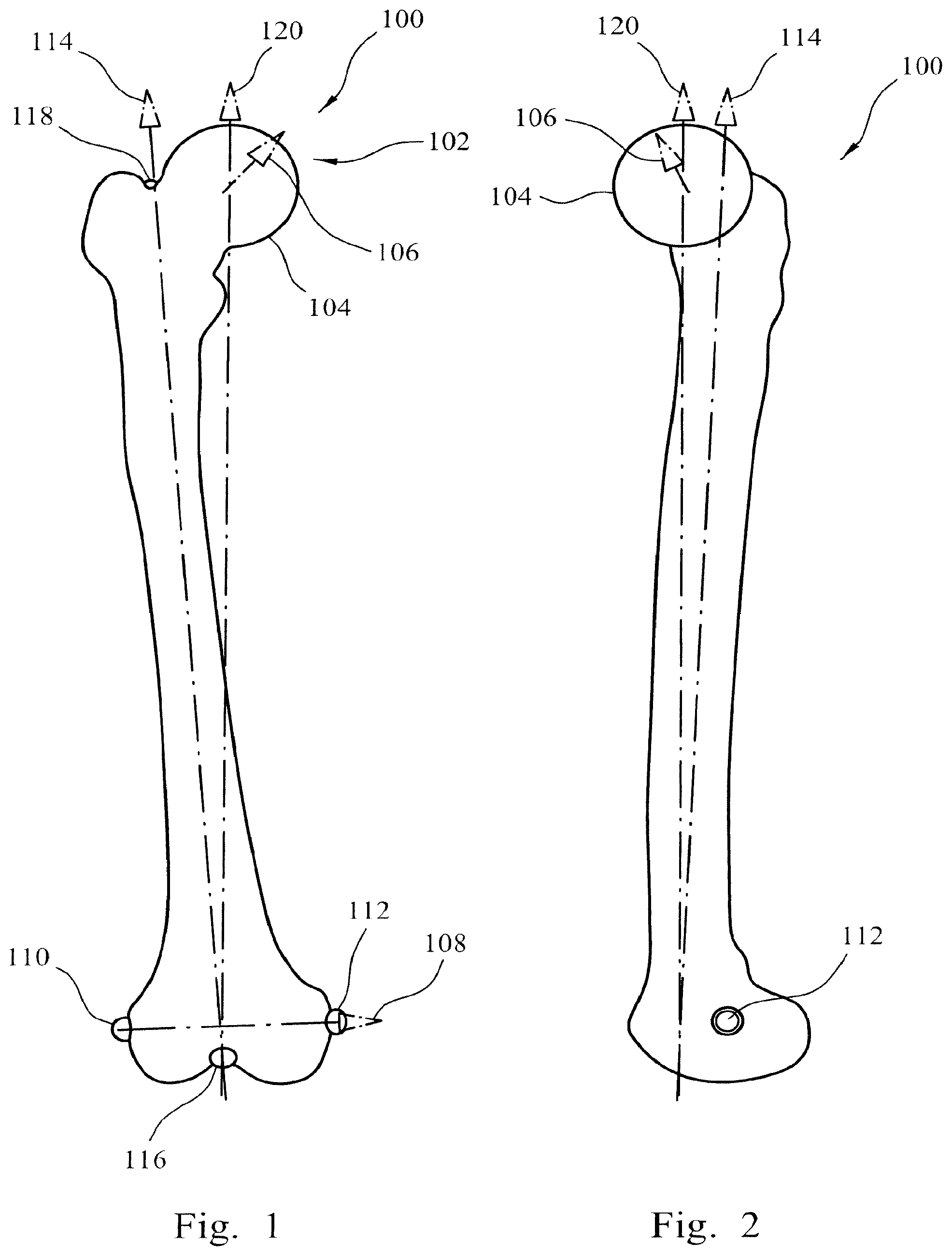 Patent US12564500 Figure 1 – Femoral trialling kit and assembly