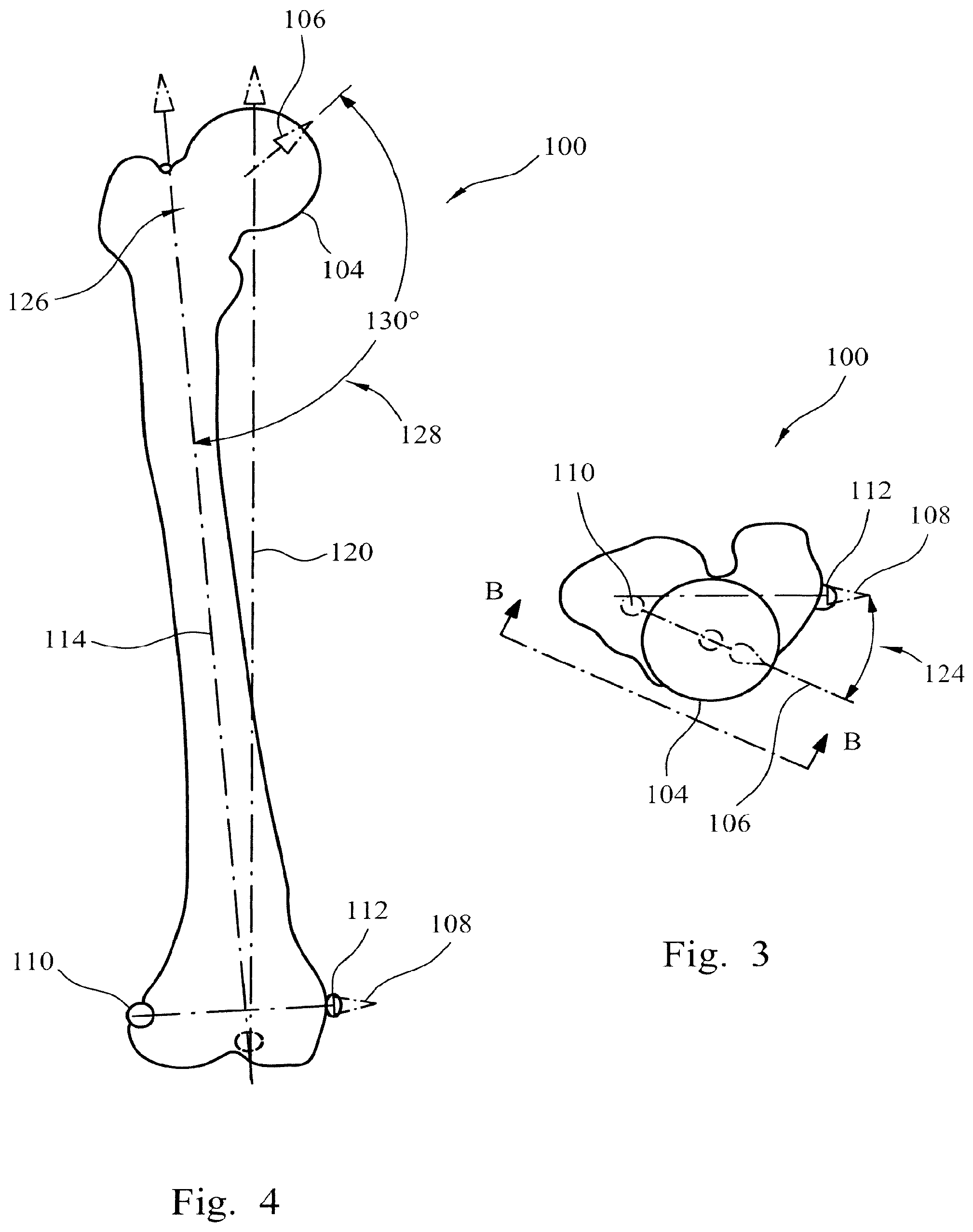 Patent US12564500 Figure 2 – Femoral trialling kit and assembly