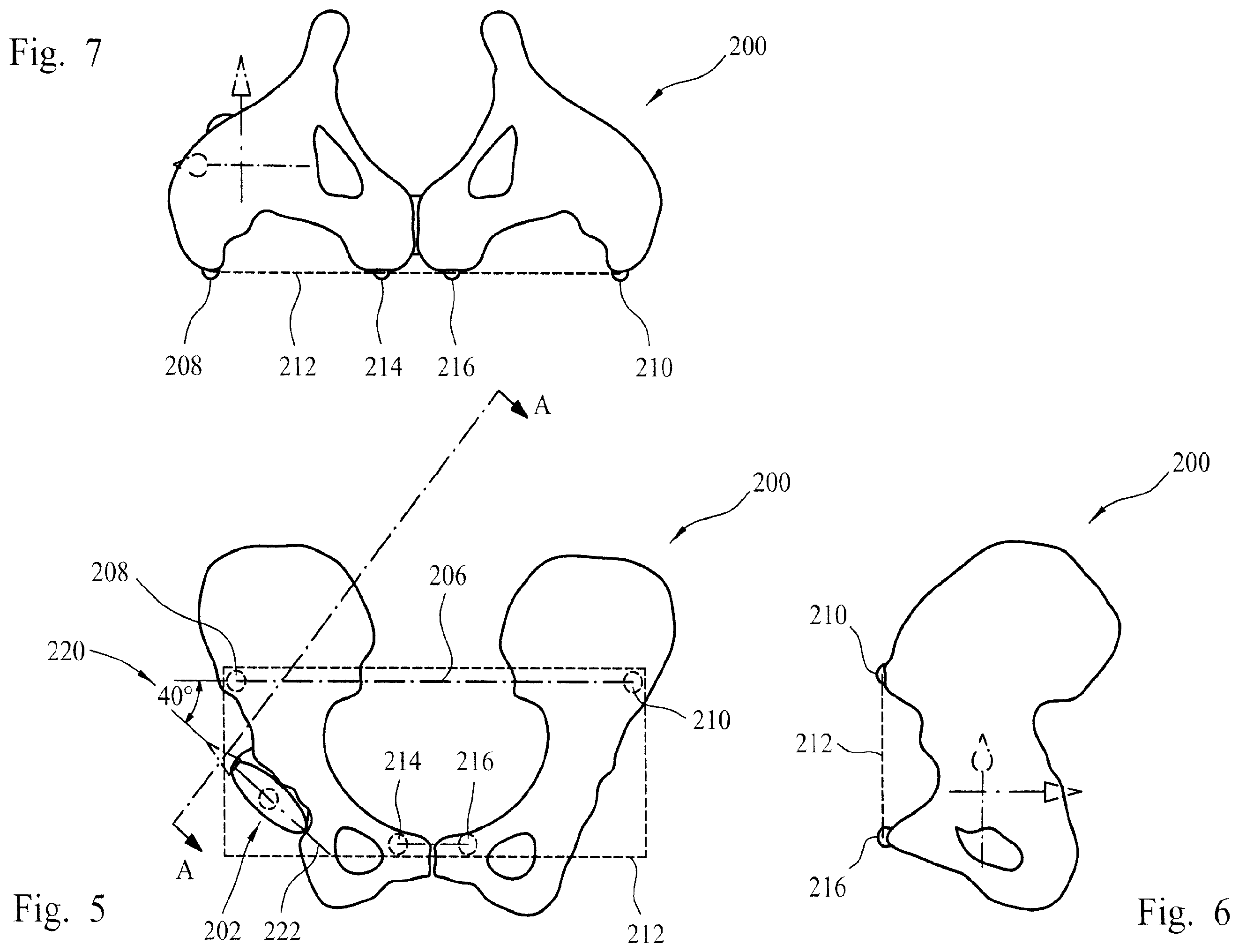 Patent US12564500 Figure 3 – Femoral trialling kit and assembly