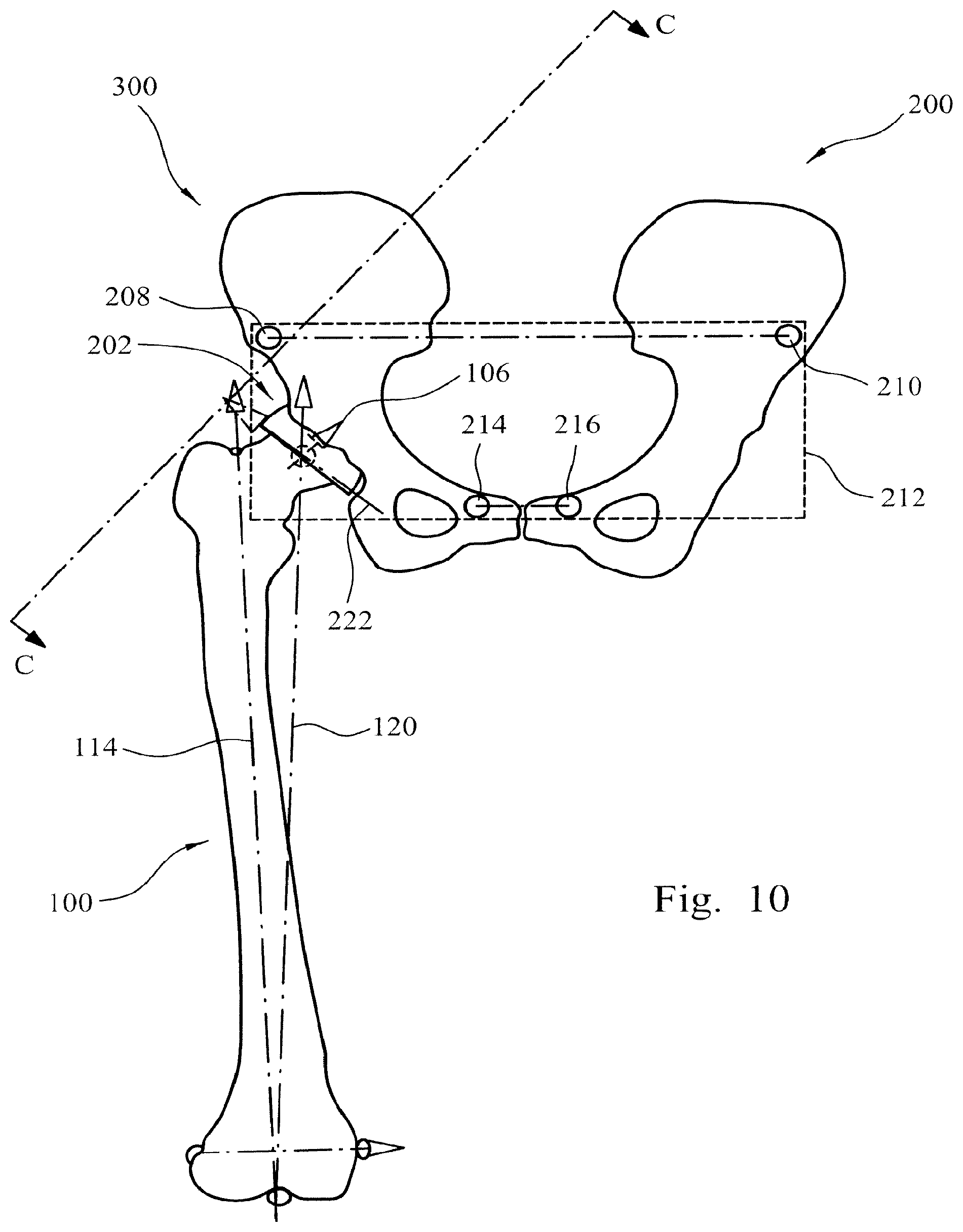 Patent US12564500 Figure 5 – Femoral trialling kit and assembly
