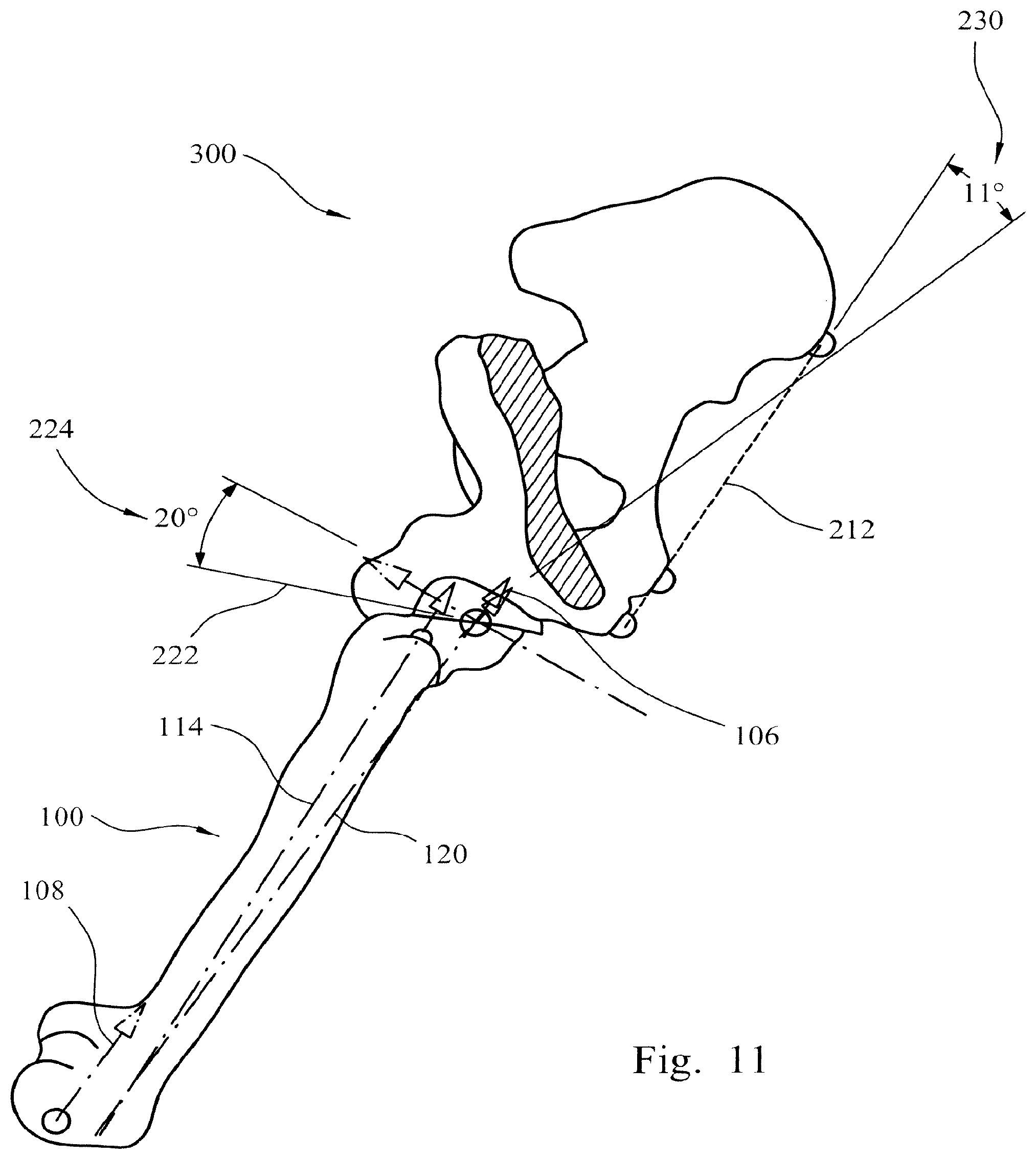 Patent US12564500 Figure 6 – Femoral trialling kit and assembly