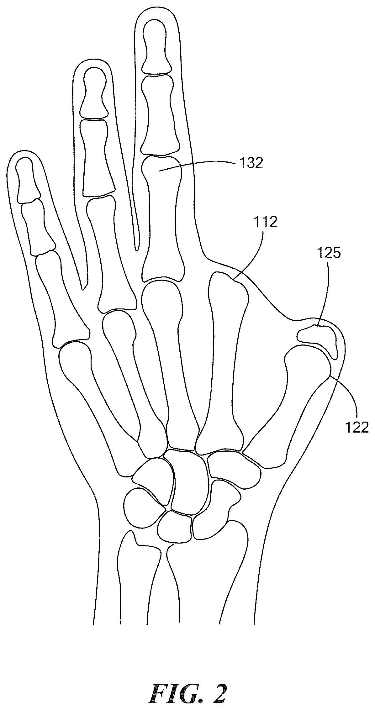 Patent US12564501 Figure 2 – Partial hand prosthesis