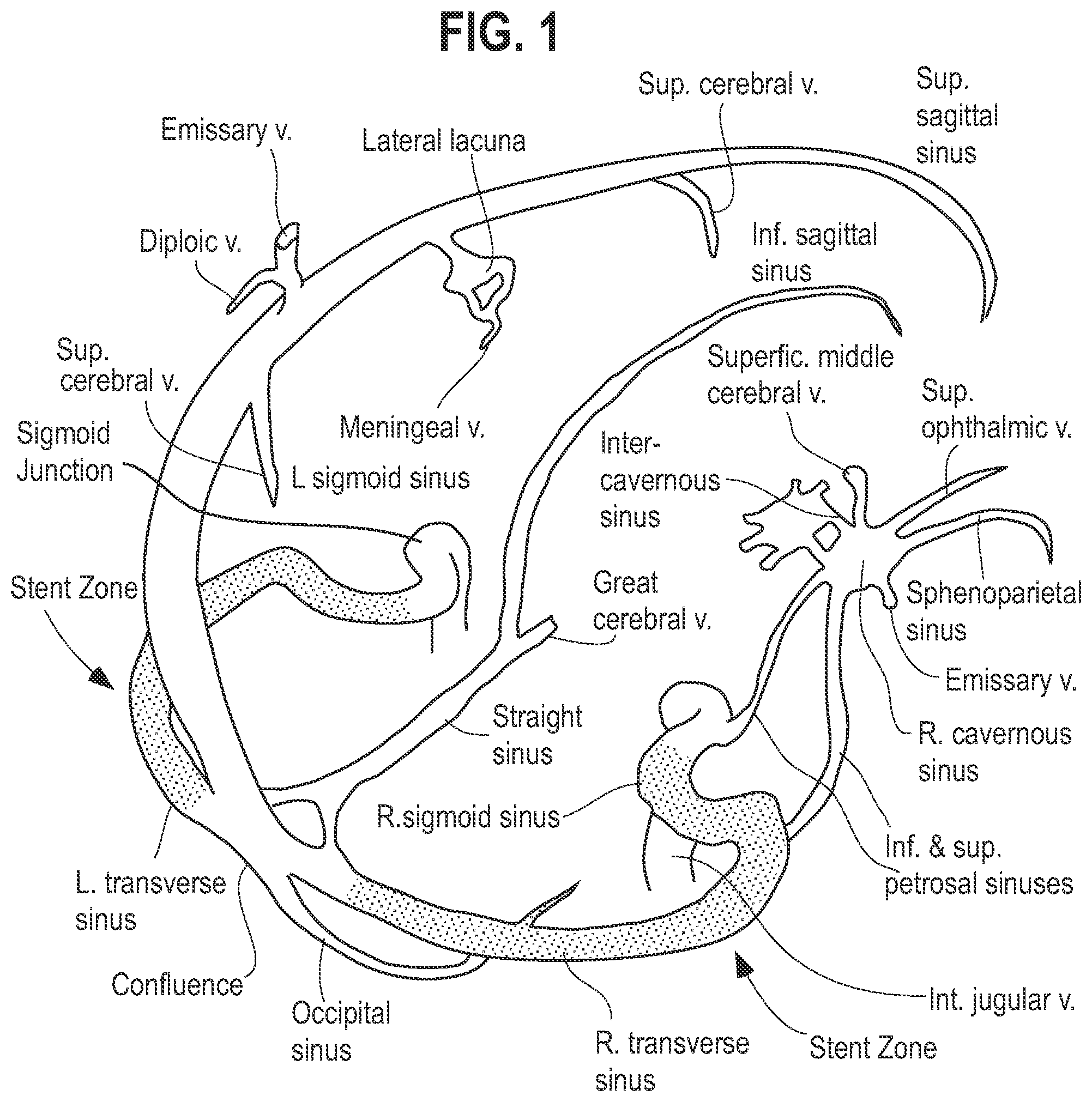 Patent US12564504 Figure 1 – Method and system for delivering a self-expanding stent to the venous sinuses