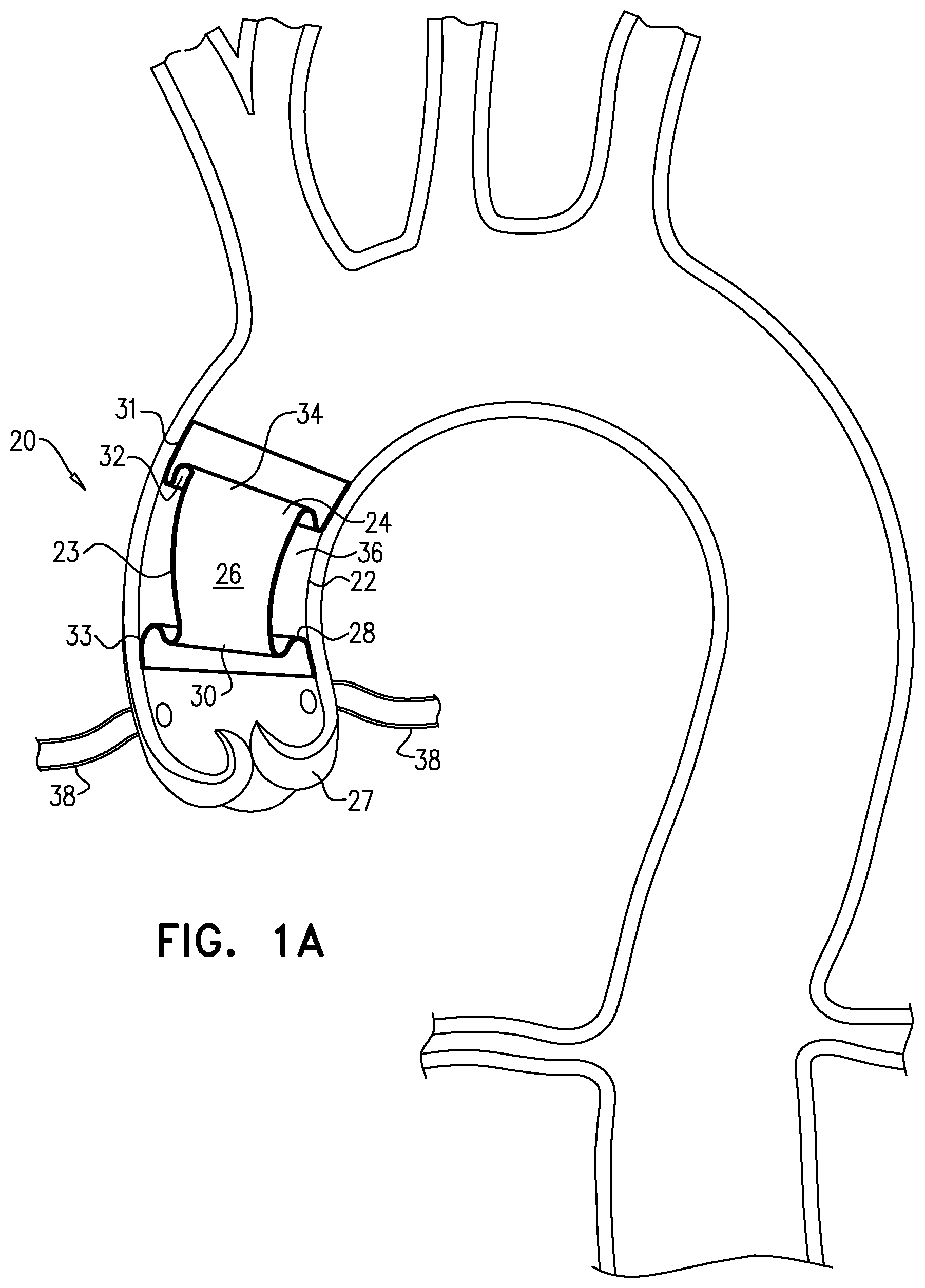 Patent US12564505 Figure 1 – Aortic pressure loss reduction apparatus and methods
