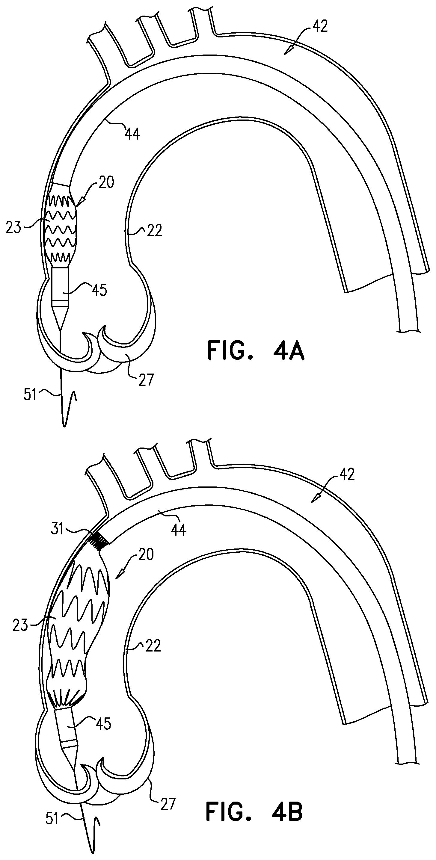 Patent US12564505 Figure 6 – Aortic pressure loss reduction apparatus and methods