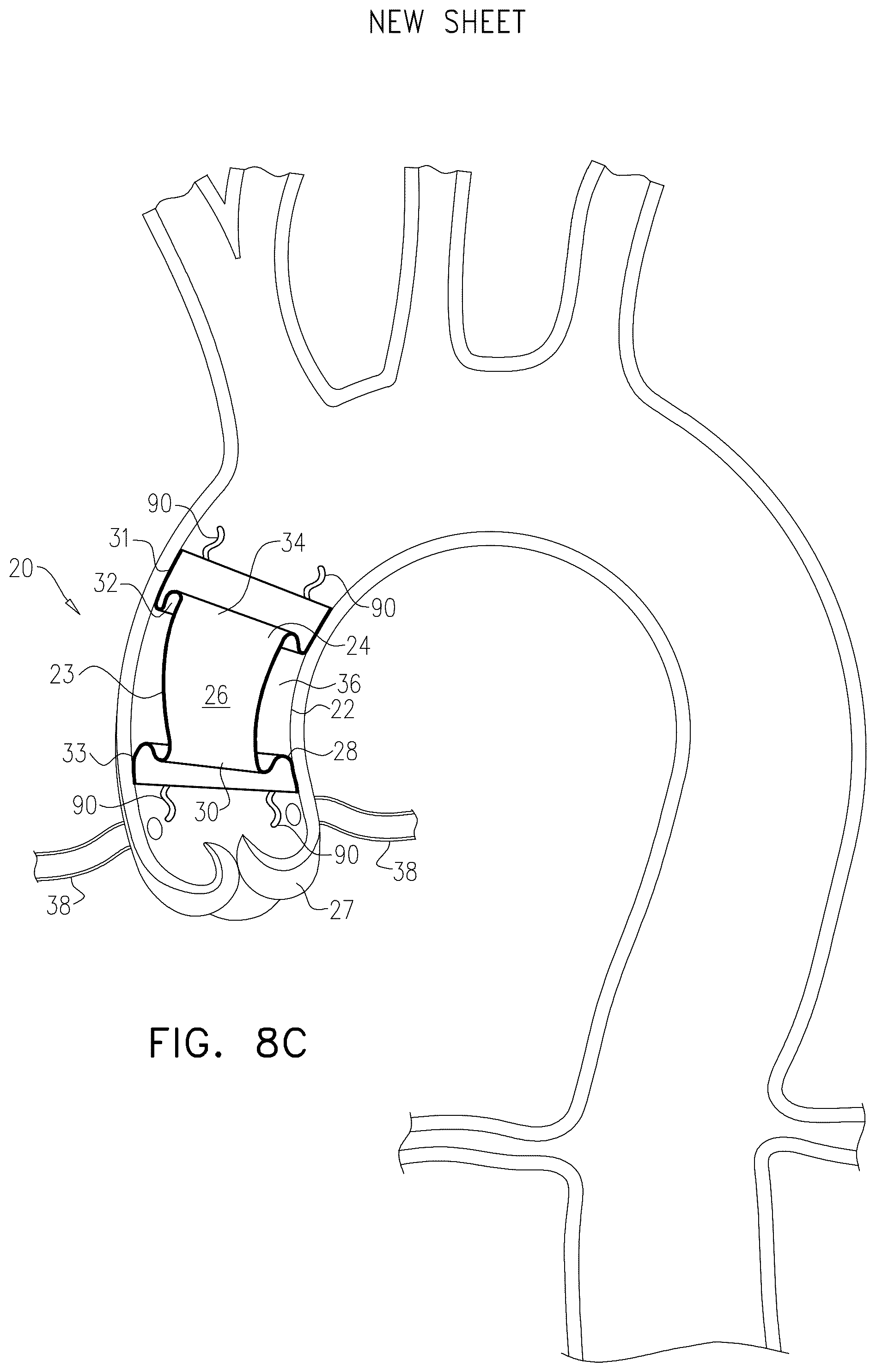 Patent US12564505 Figure 12 – Aortic pressure loss reduction apparatus and methods