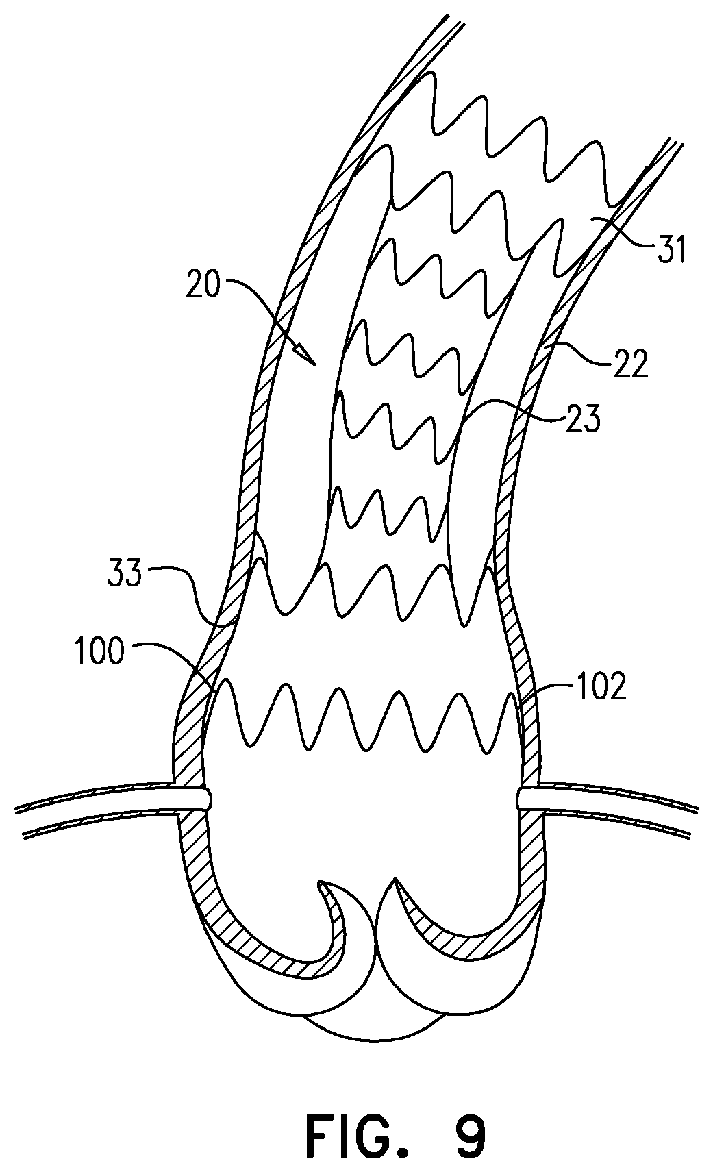 Patent US12564505 Figure 13 – Aortic pressure loss reduction apparatus and methods