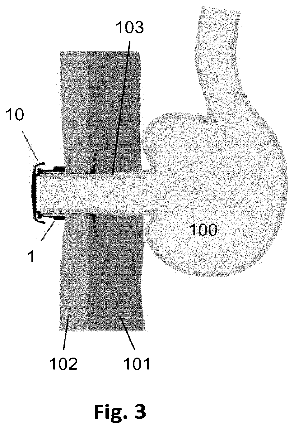Patent US12564511 Figure 2 – Lid for an ostomy implant