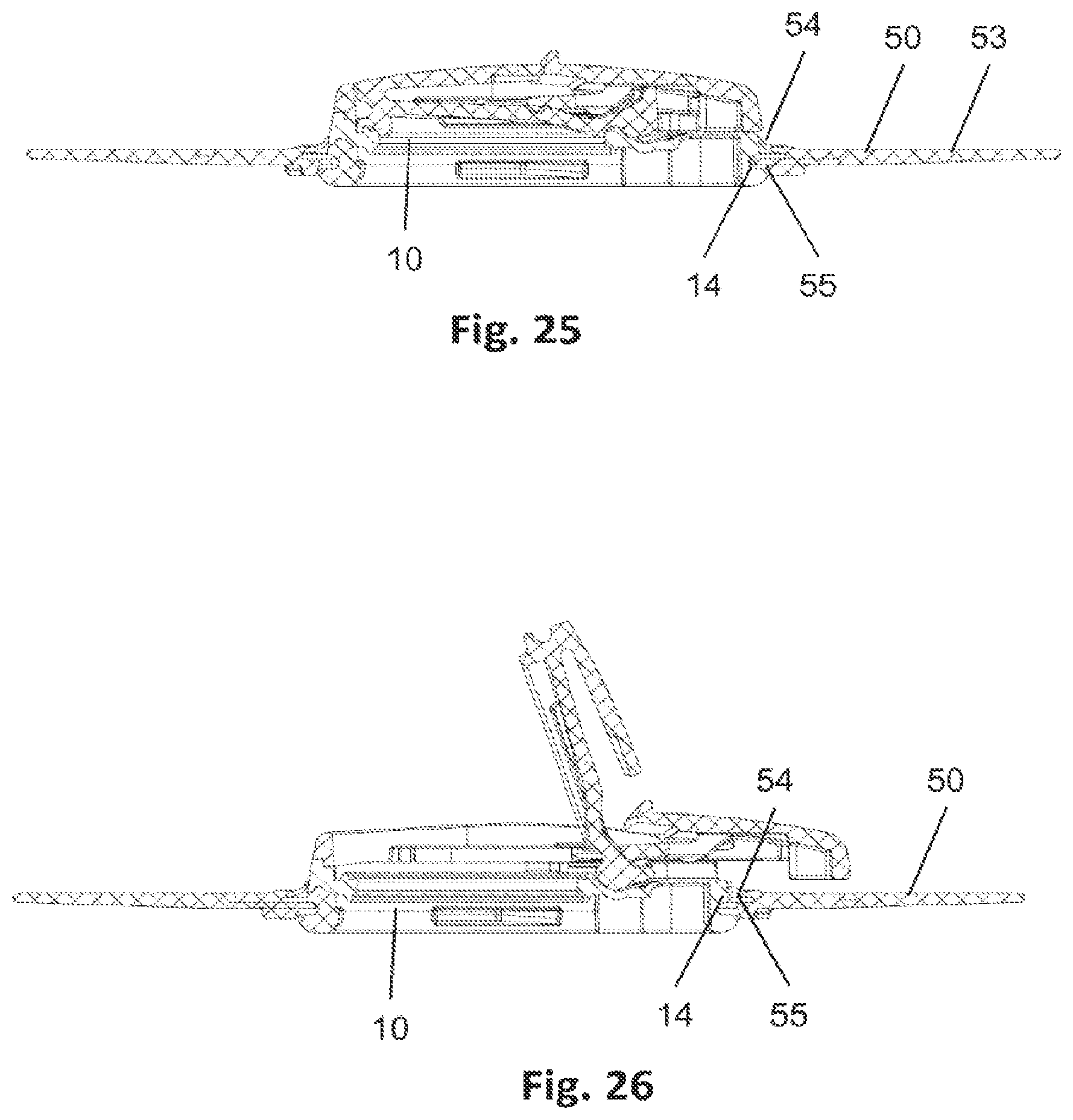 Patent US12564511 Figure 14 – Lid for an ostomy implant