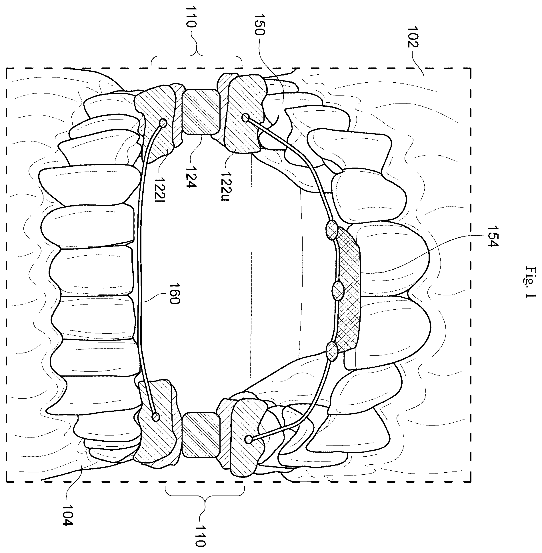 Patent US12564512 Figure 1 – Configurable breathing assist mouthpiece device