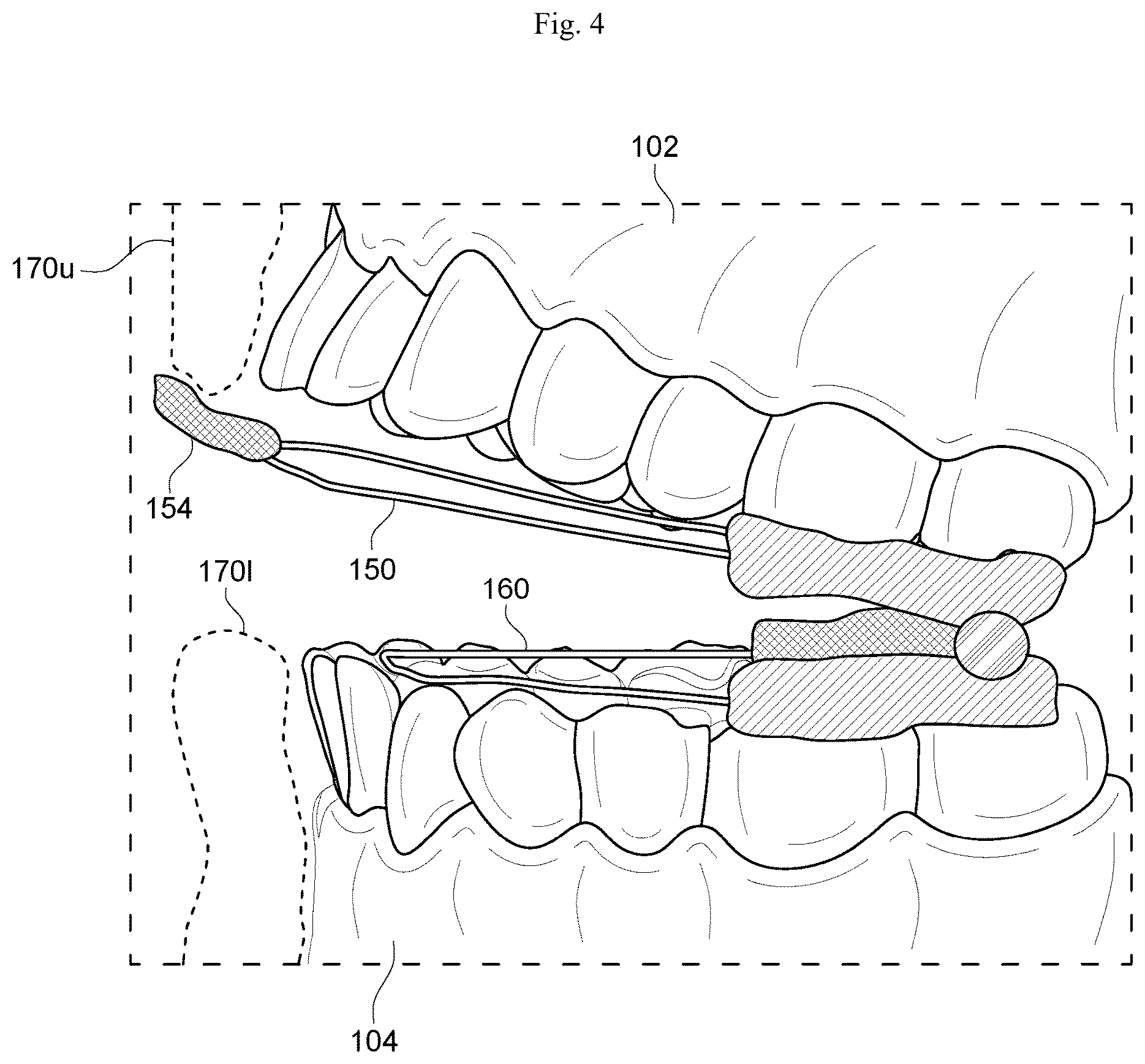 Patent US12564512 Figure 3 – Configurable breathing assist mouthpiece device