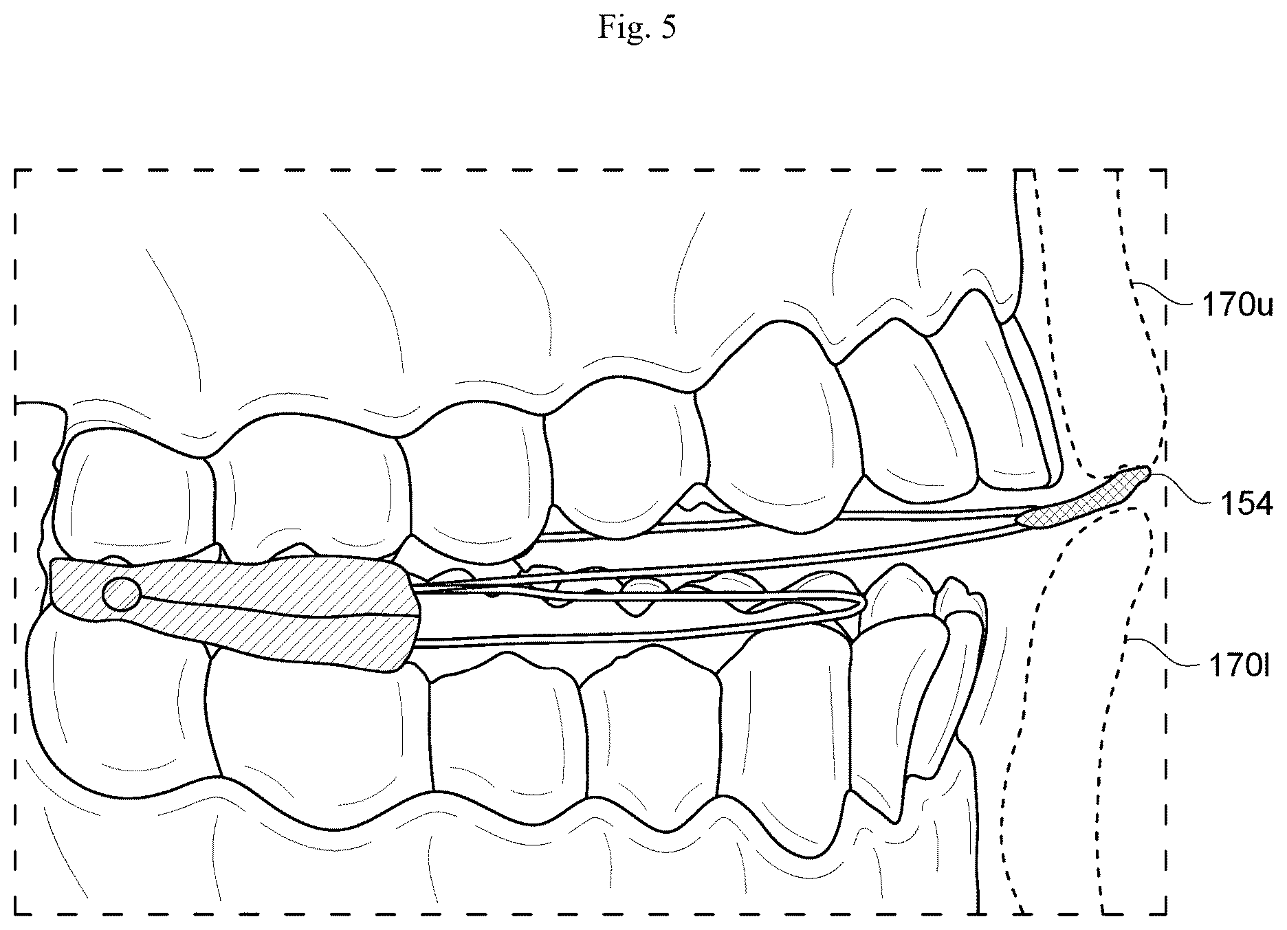 Patent US12564512 Figure 4 – Configurable breathing assist mouthpiece device