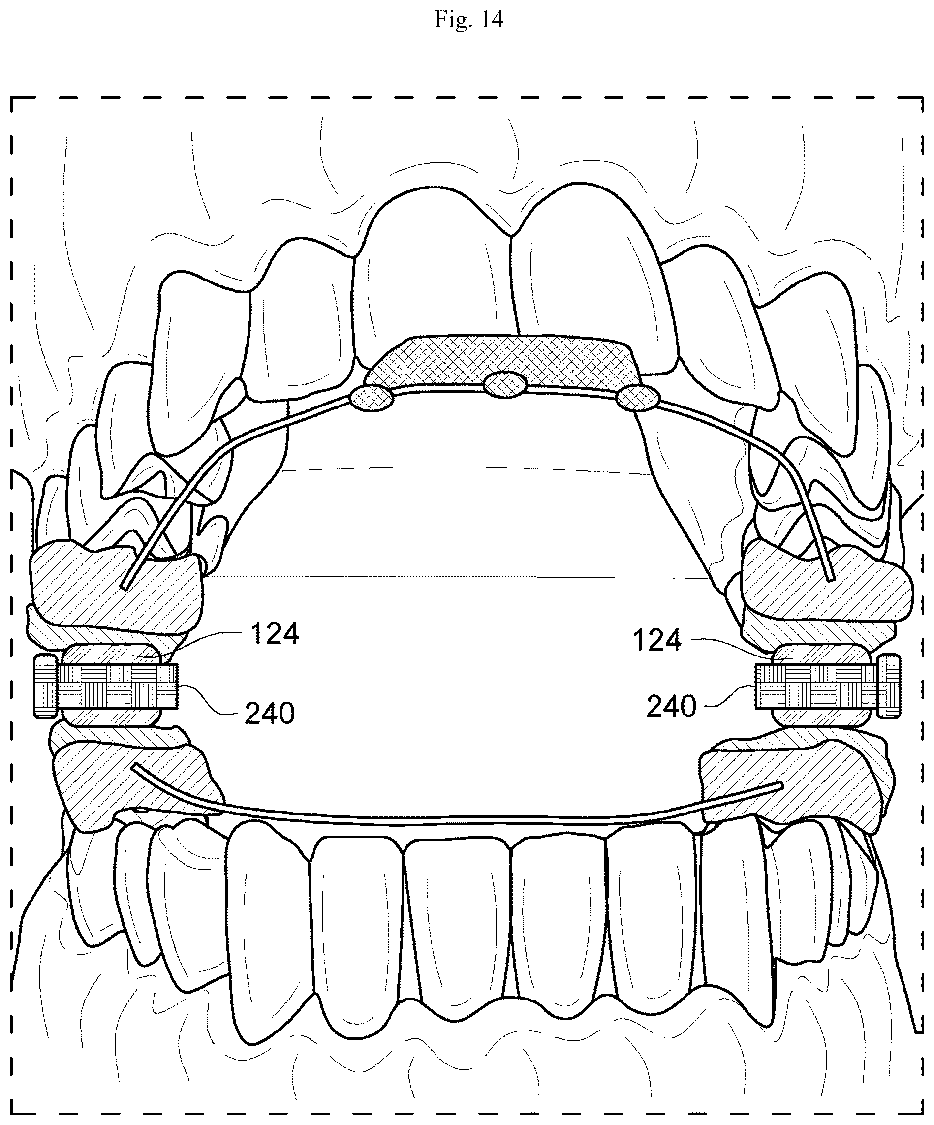 Patent US12564512 Figure 9 – Configurable breathing assist mouthpiece device