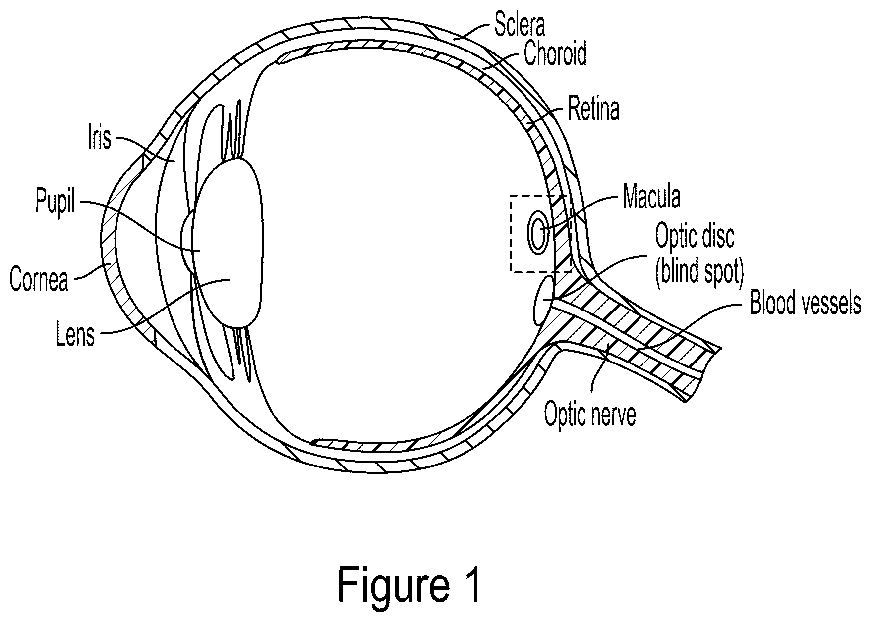 Patent US12564513 Figure 1 – Tool for macular elevation