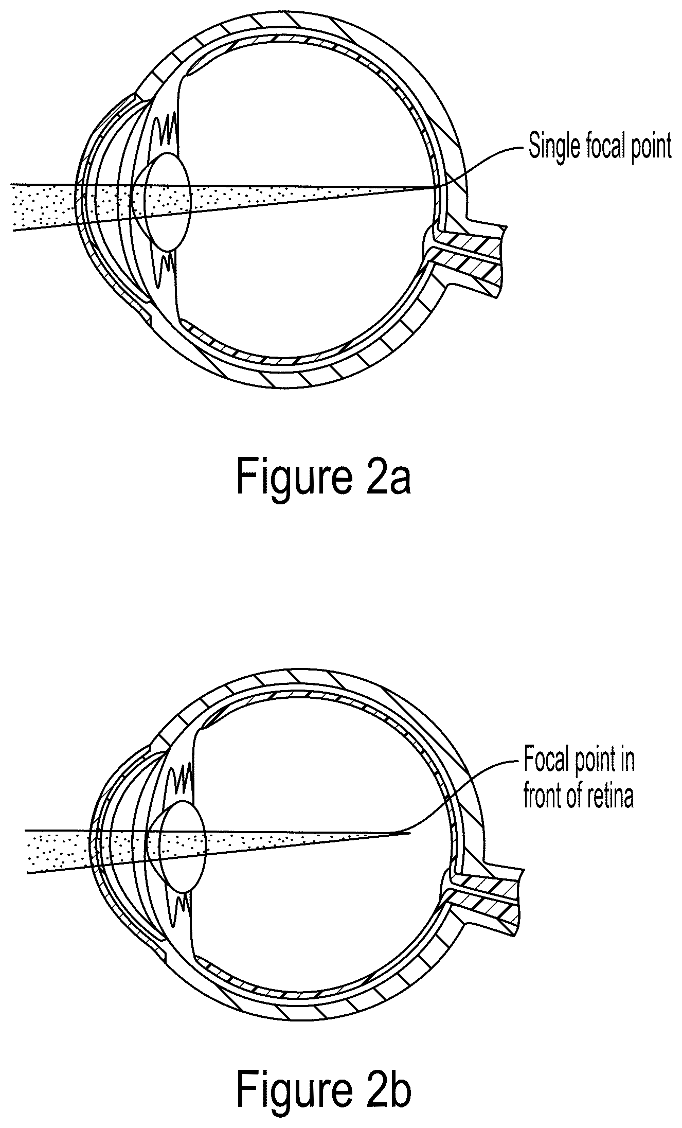 Patent US12564513 Figure 2 – Tool for macular elevation