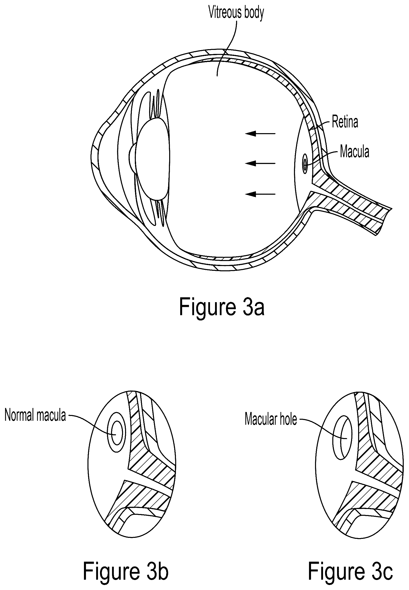 Patent US12564513 Figure 3 – Tool for macular elevation