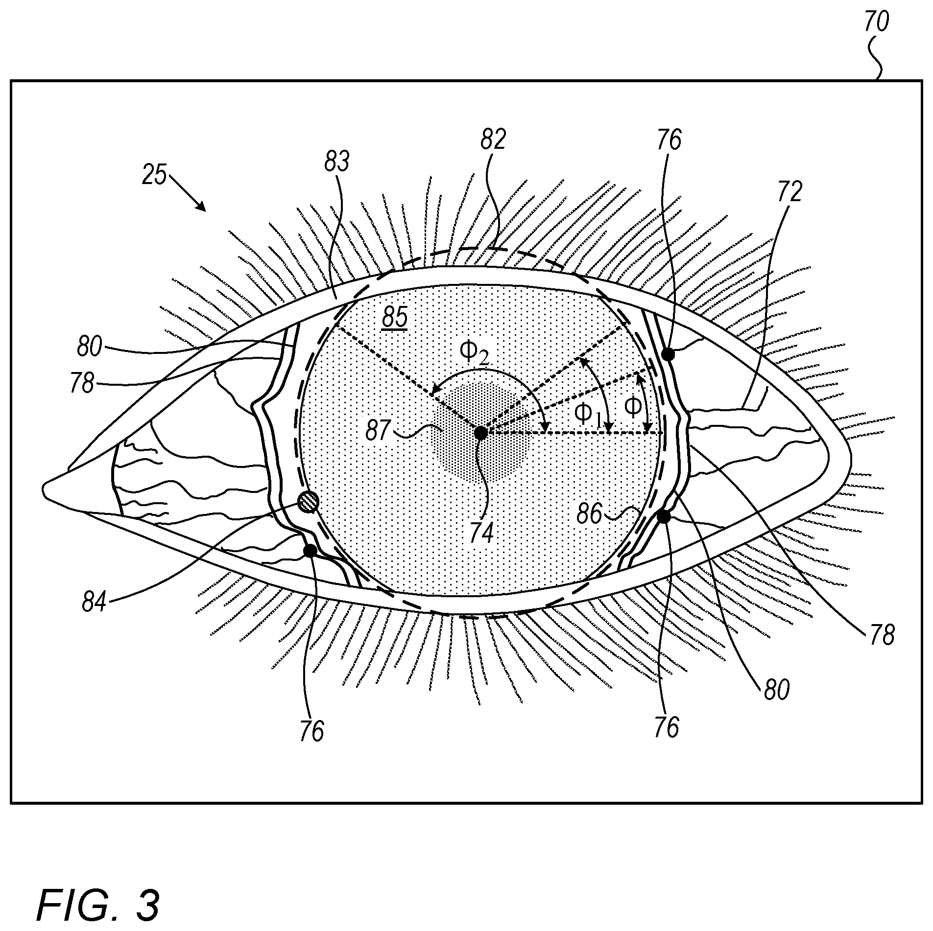 Patent US12564517 Figure 3 – Avoiding blood vessels during direct selective laser trabeculoplasty