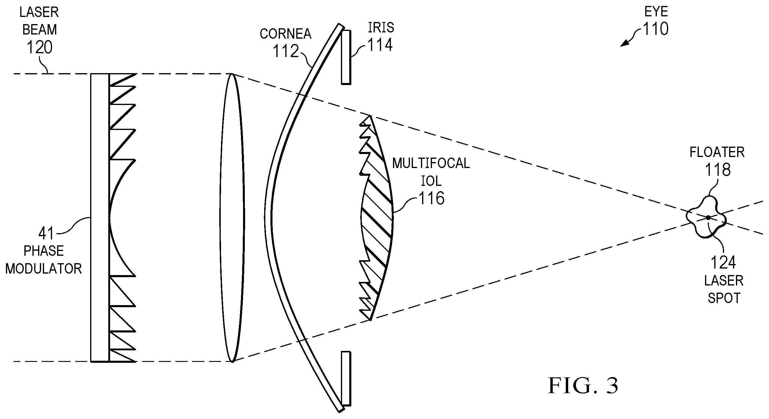 Patent US12564518 Figure 3 – Performing laser vitreolysis on an eye with an intraocular lens