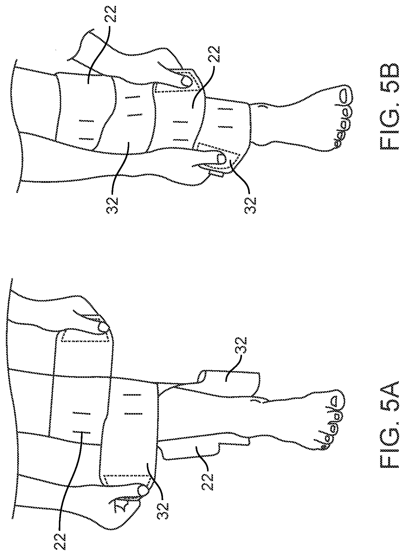 Patent US12564520 Figure 6 – Graduated compression device for the treatment of circulatory disorders