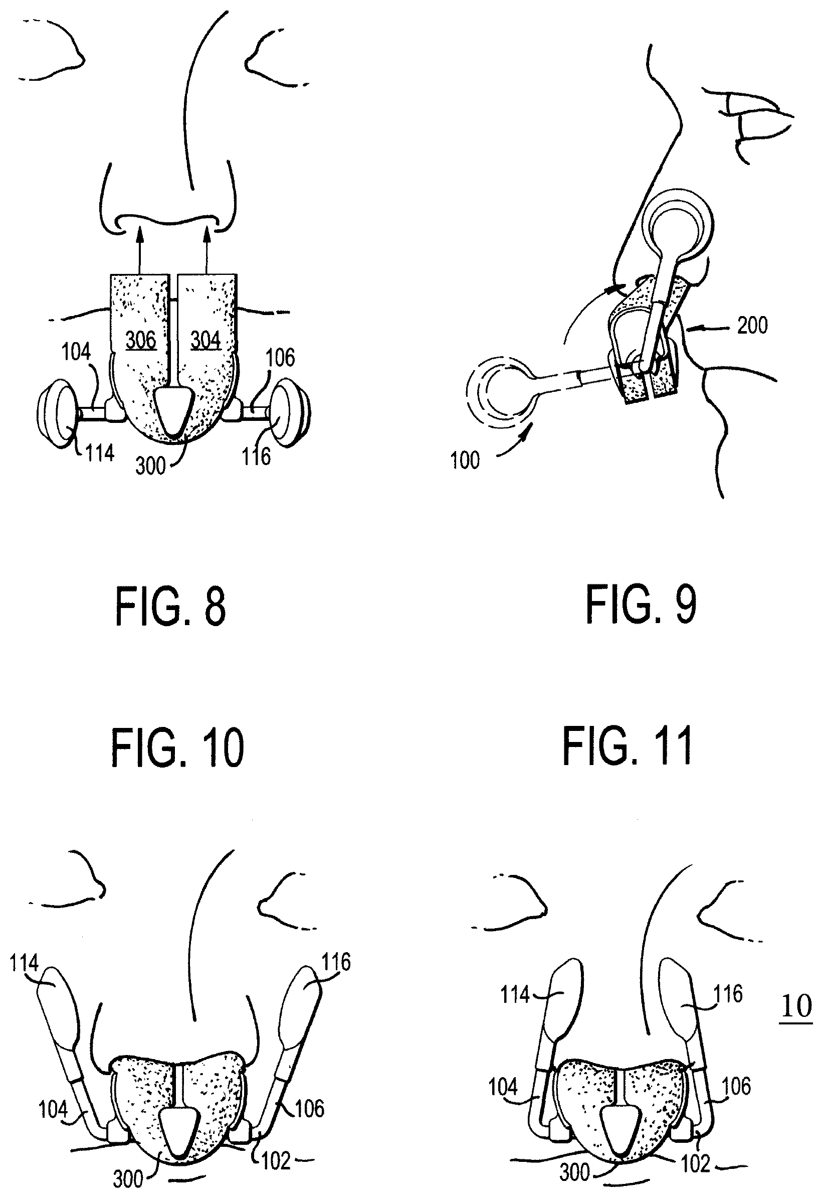 Patent US12564521 Figure 3 – Nasal compression device