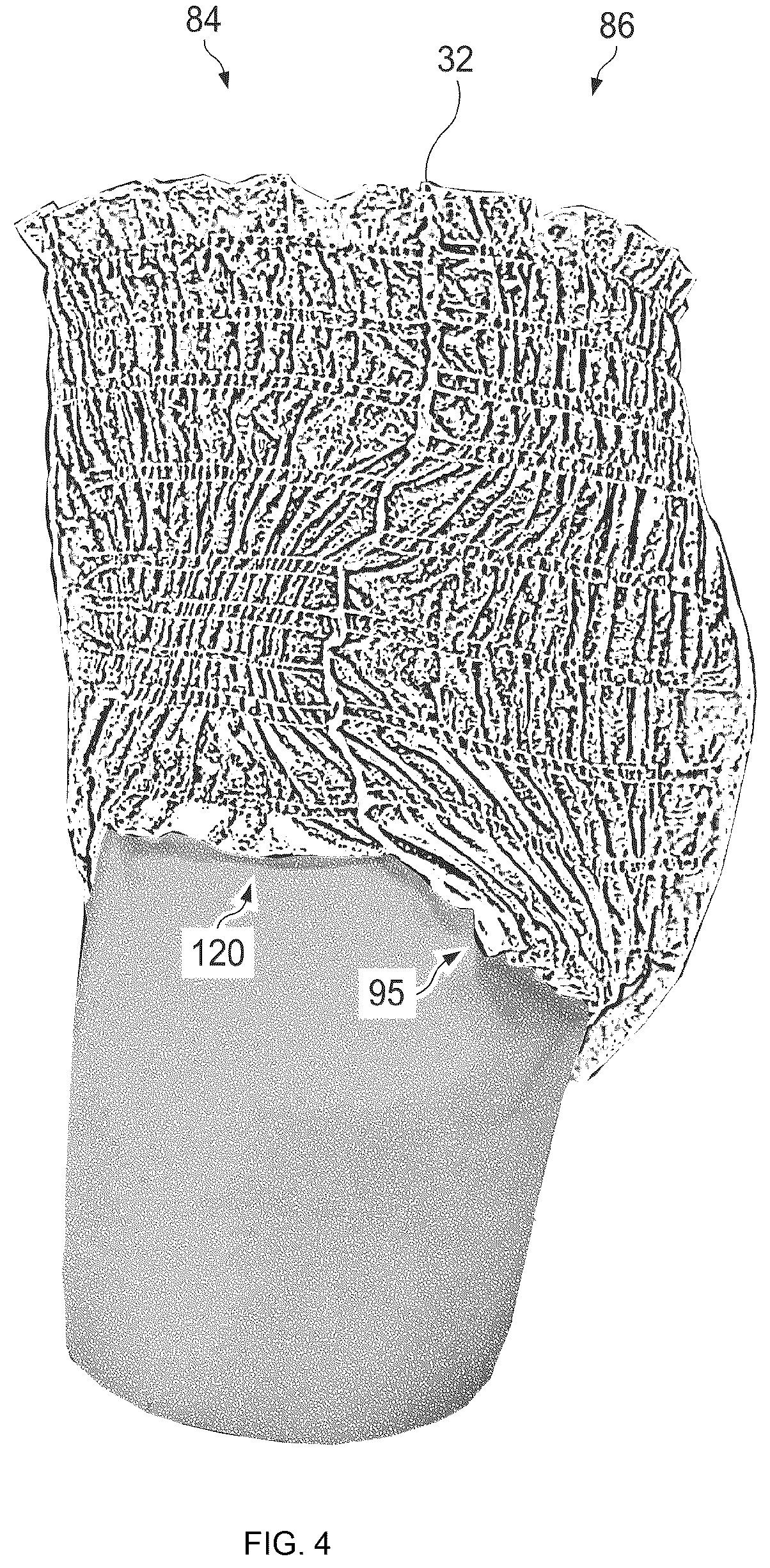 Patent US12564522 Figure 5 – Pant-type absorbent article with waist guard