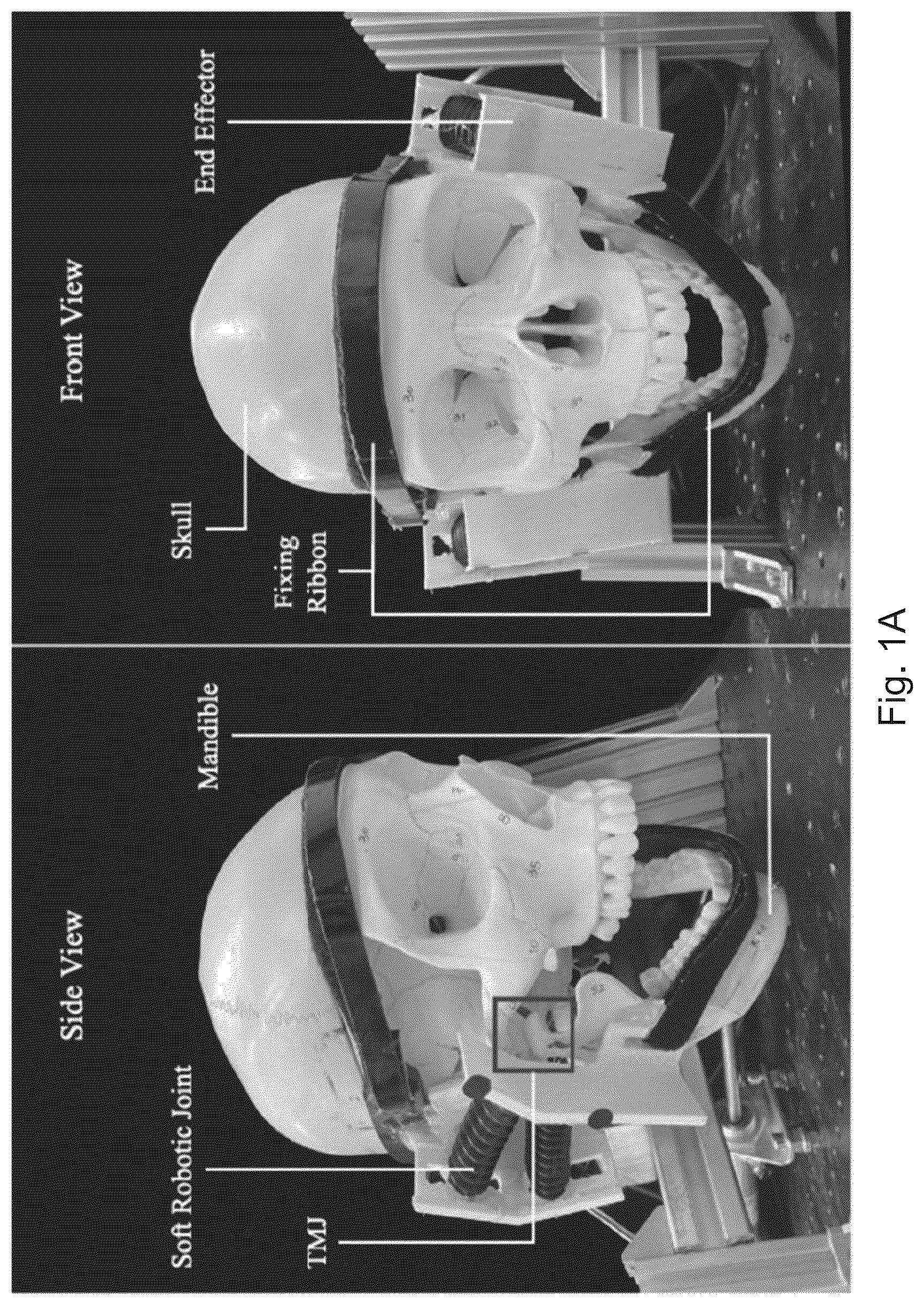 Patent US12564531 — Soft exoskeleton wearable device for temporomandibular disorder (TMD) rehabilitation — Figure 1