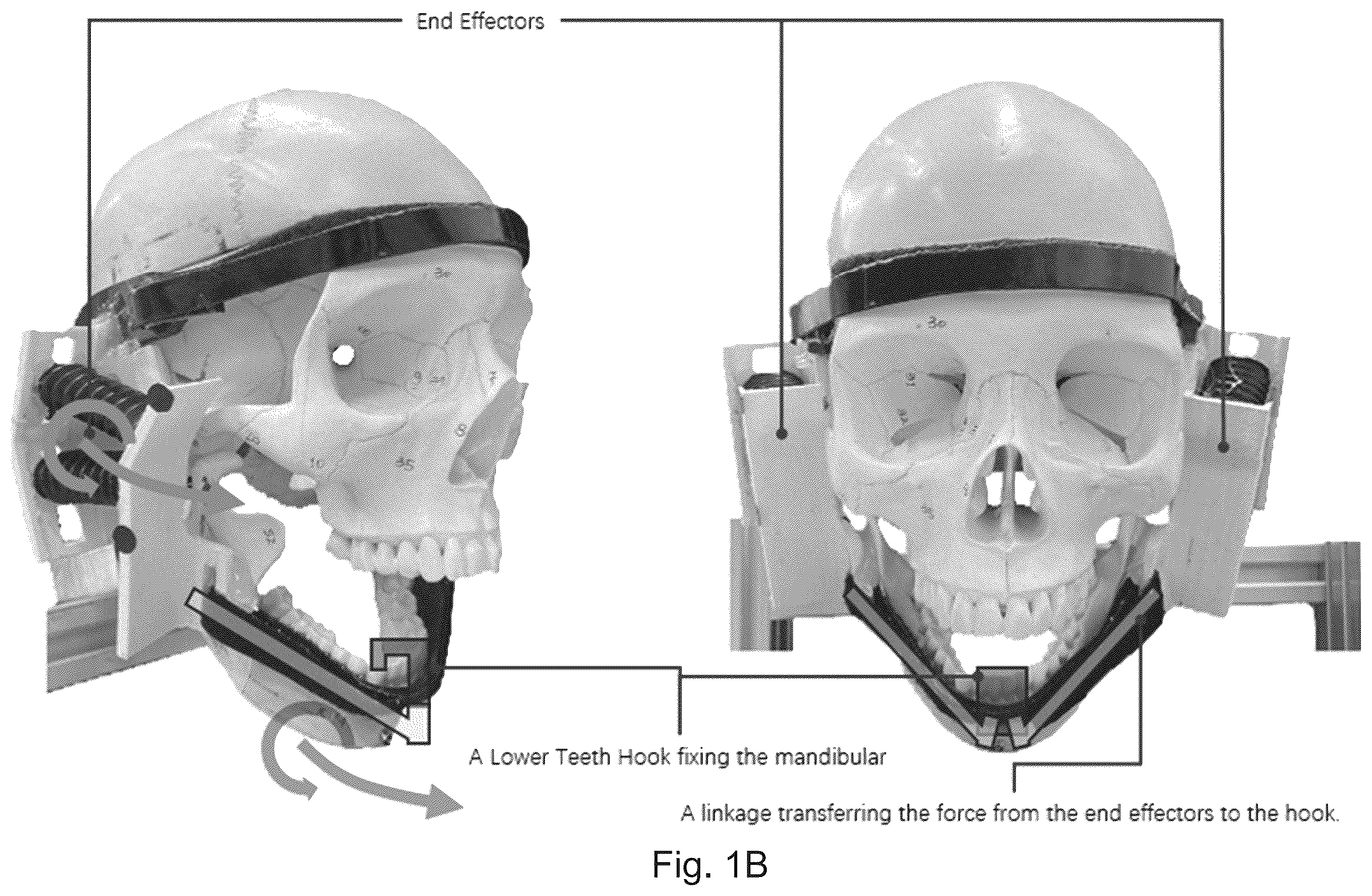 Patent US12564531 Figure 2 – Soft exoskeleton wearable device for temporomandibular disorder (TMD) rehabilitation