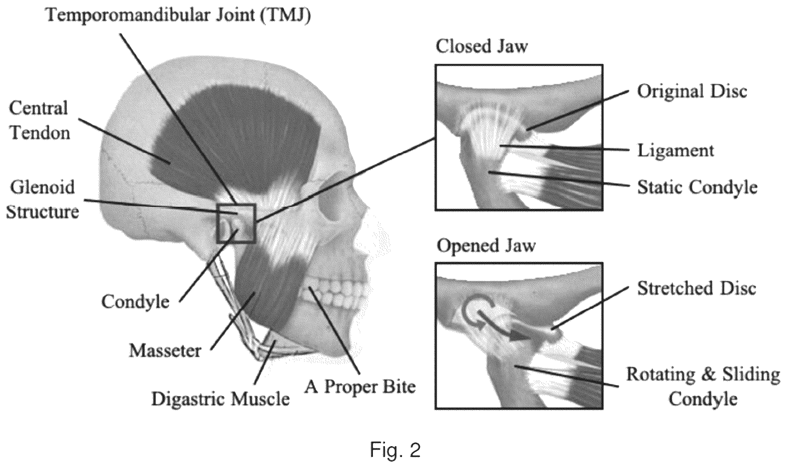 Patent US12564531 Figure 3 – Soft exoskeleton wearable device for temporomandibular disorder (TMD) rehabilitation