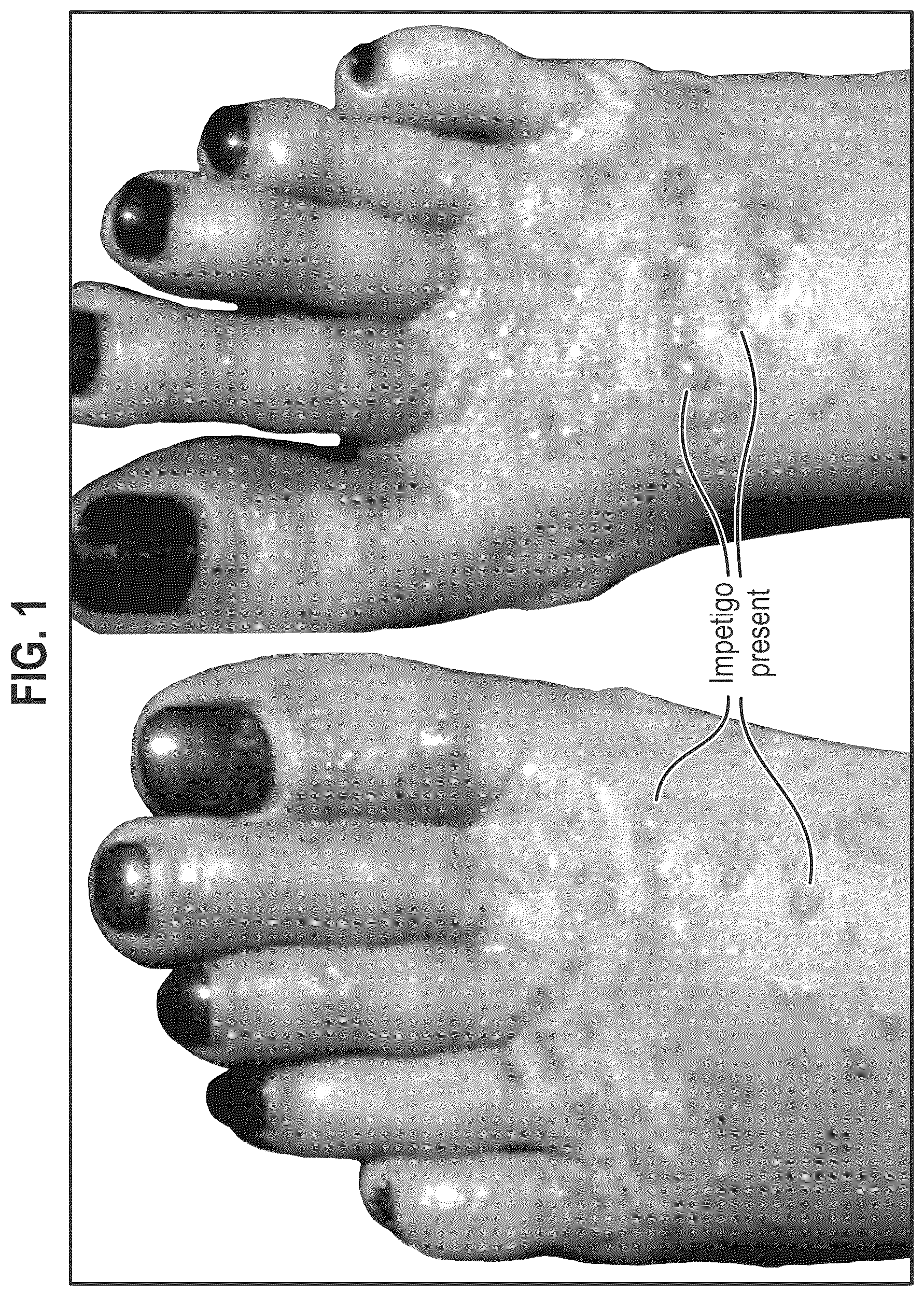 Patent US12564563 Figure 1 – Composition and methods for treating pathogenic infections on wounds