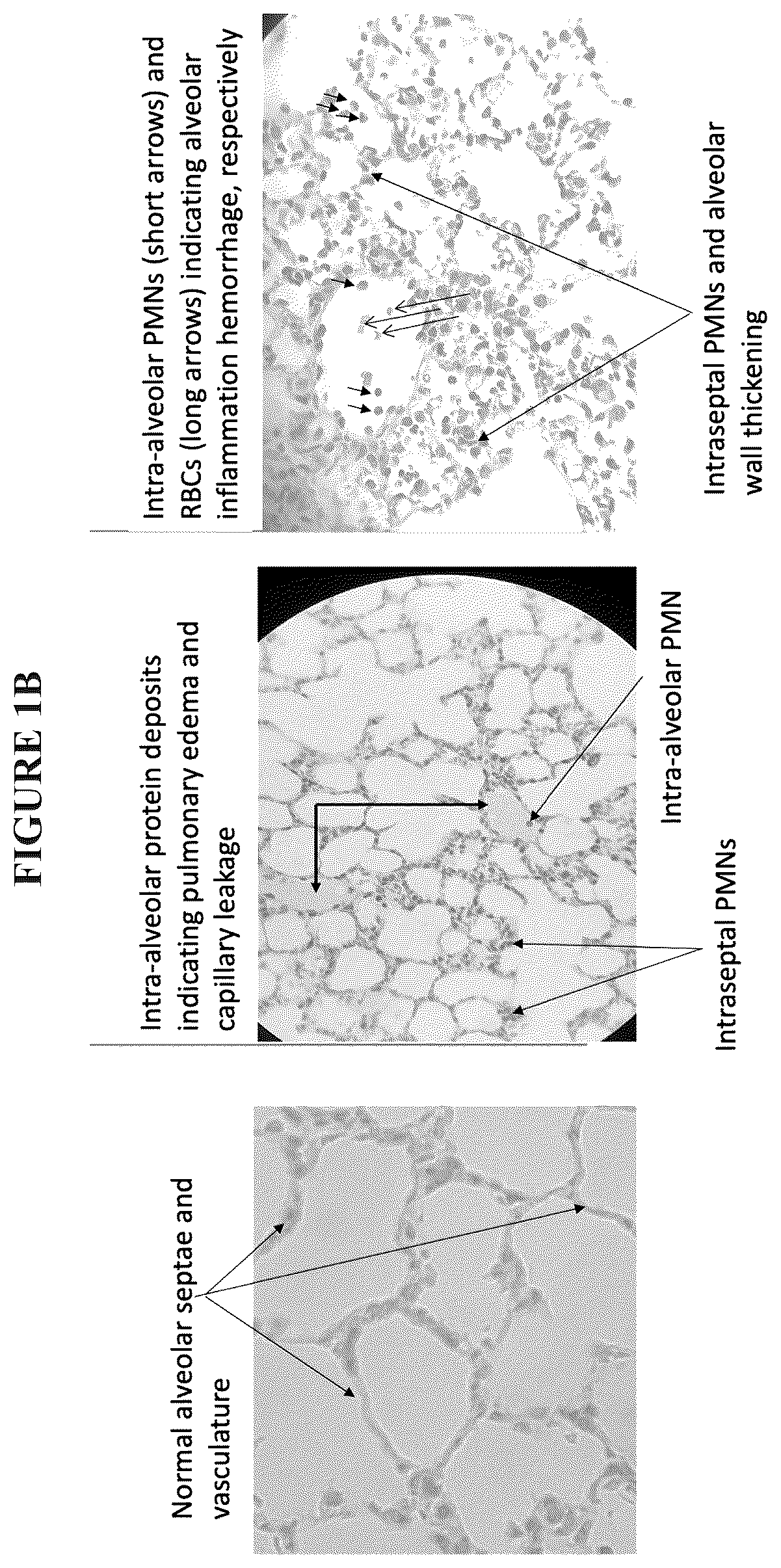 Patent US12564575 Figure 3 – Early management, mitigation and prevention of sepsis and sepsis-like syndromes, including neo-natal ARDS due to infection, injury or iatrogenesis