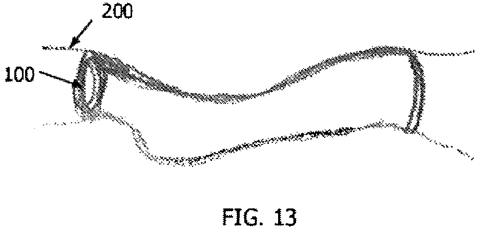 Patent US12564659 Figure 13 – Implantable scaffolds for treatment of sinusitis