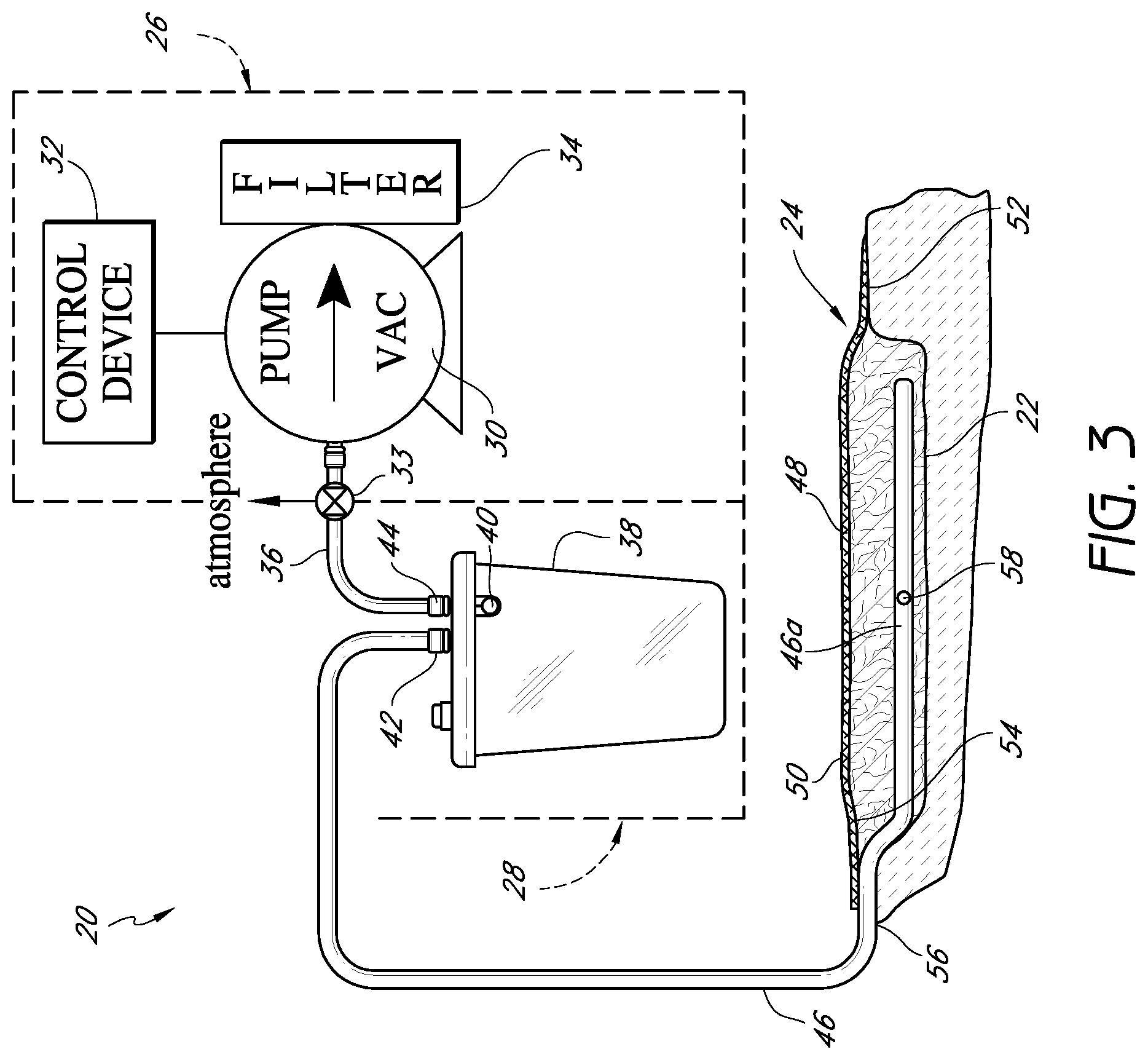 Patent US12564670 Figure 3 – Sustained variable negative pressure wound treatment and method of controlling same