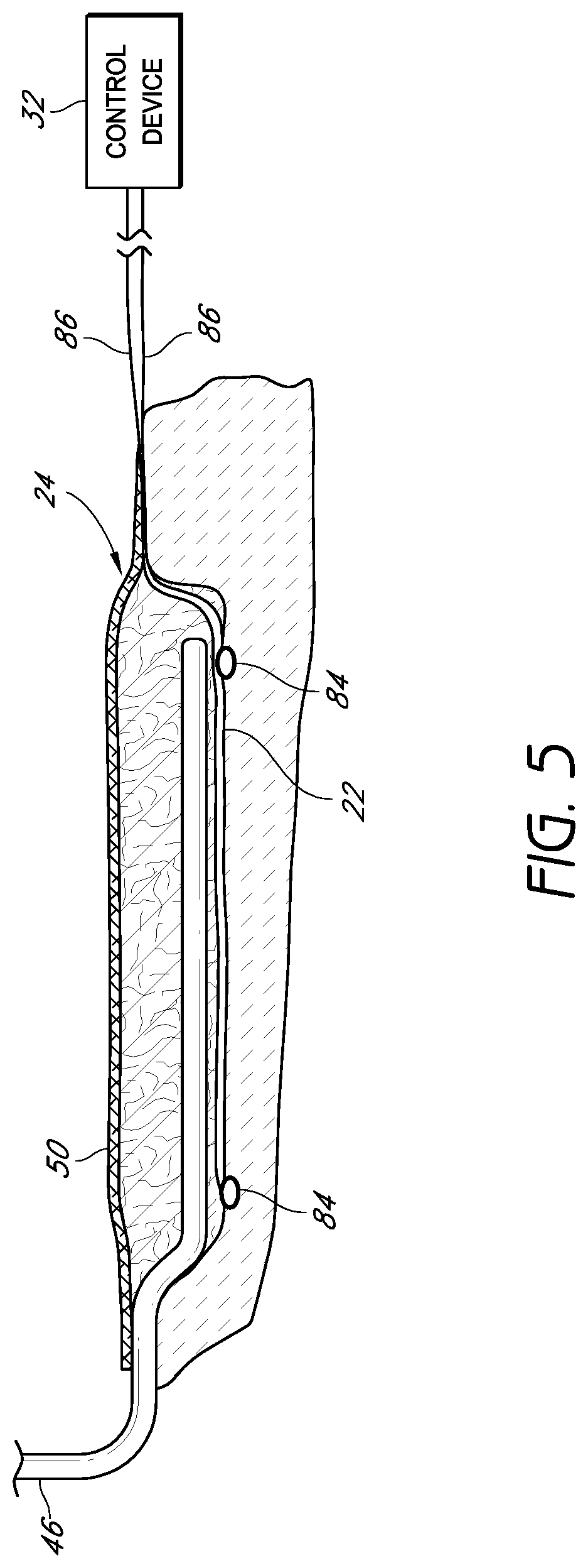 Patent US12564670 Figure 6 – Sustained variable negative pressure wound treatment and method of controlling same