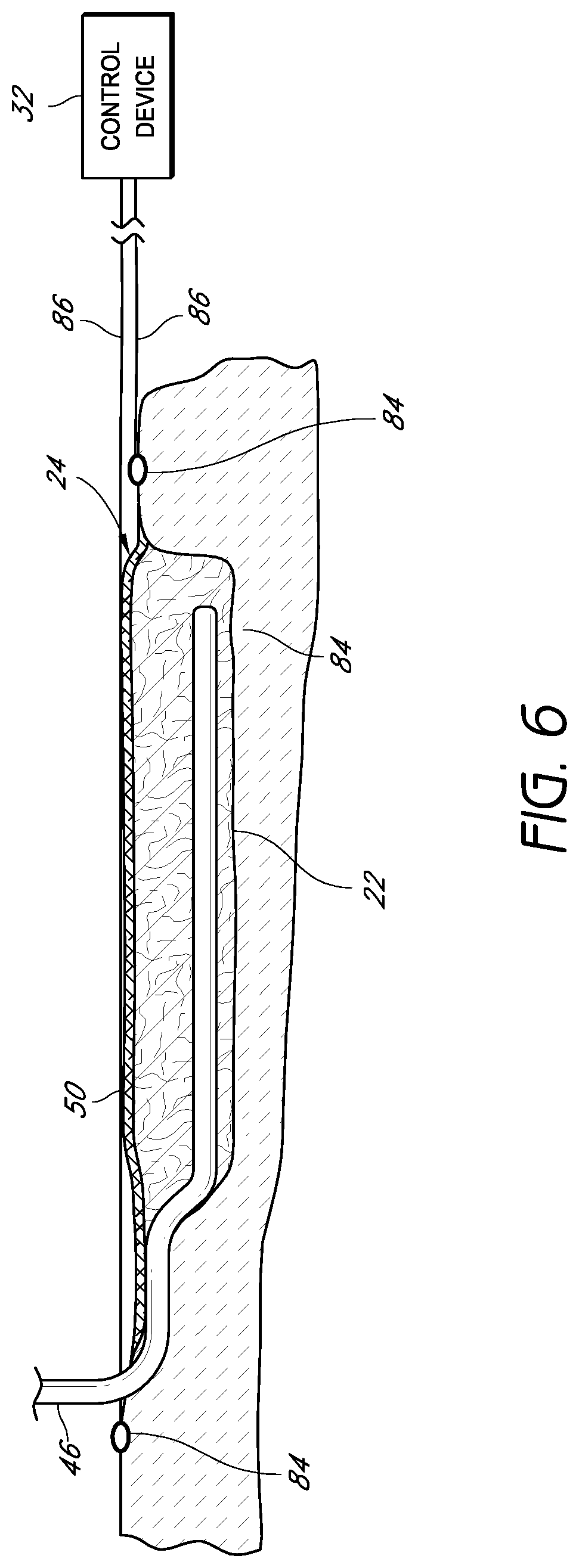 Patent US12564670 Figure 7 – Sustained variable negative pressure wound treatment and method of controlling same