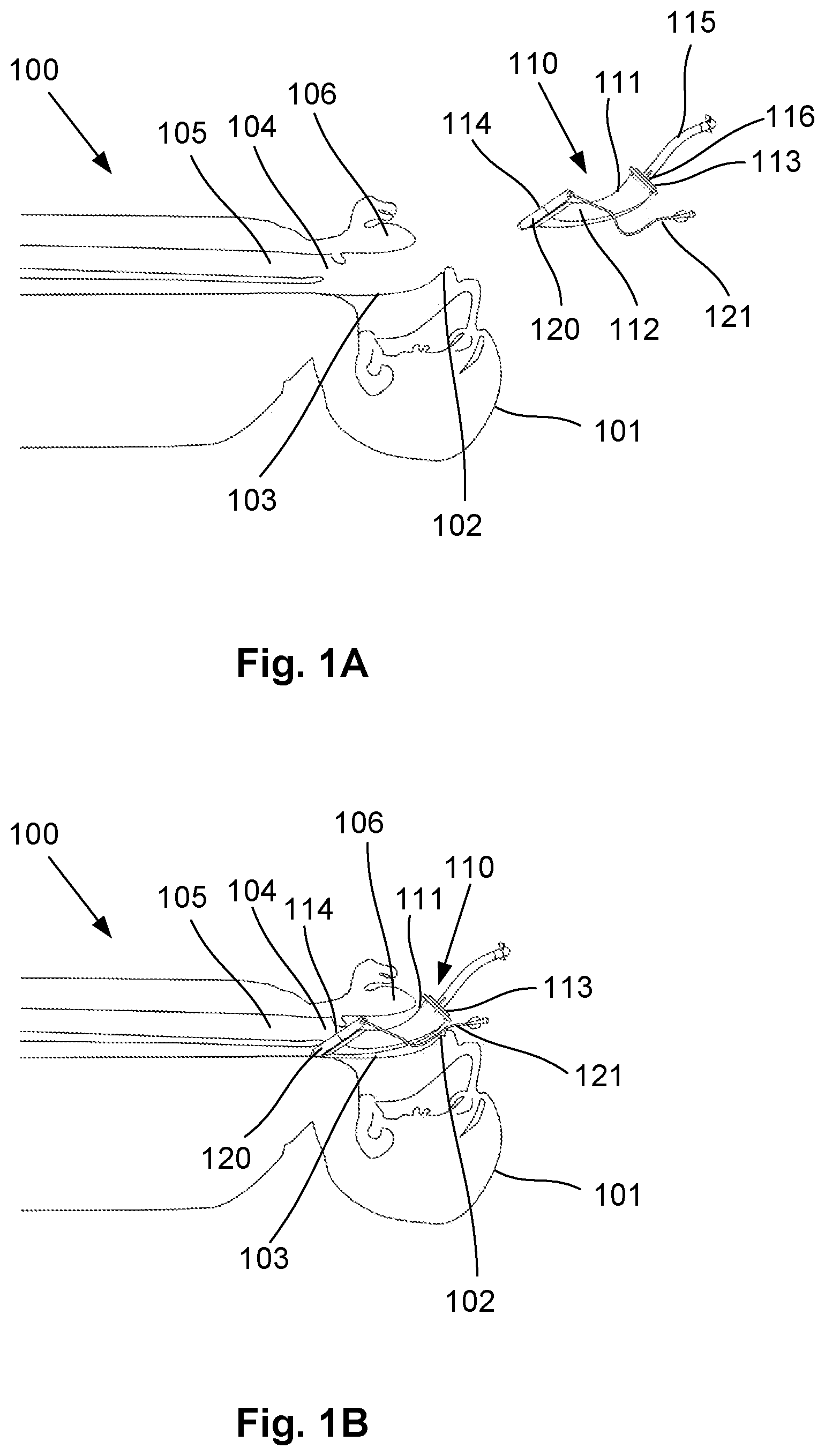 Patent US12564693 — Laryngeal mask airway intubation guide and method — Figure 1