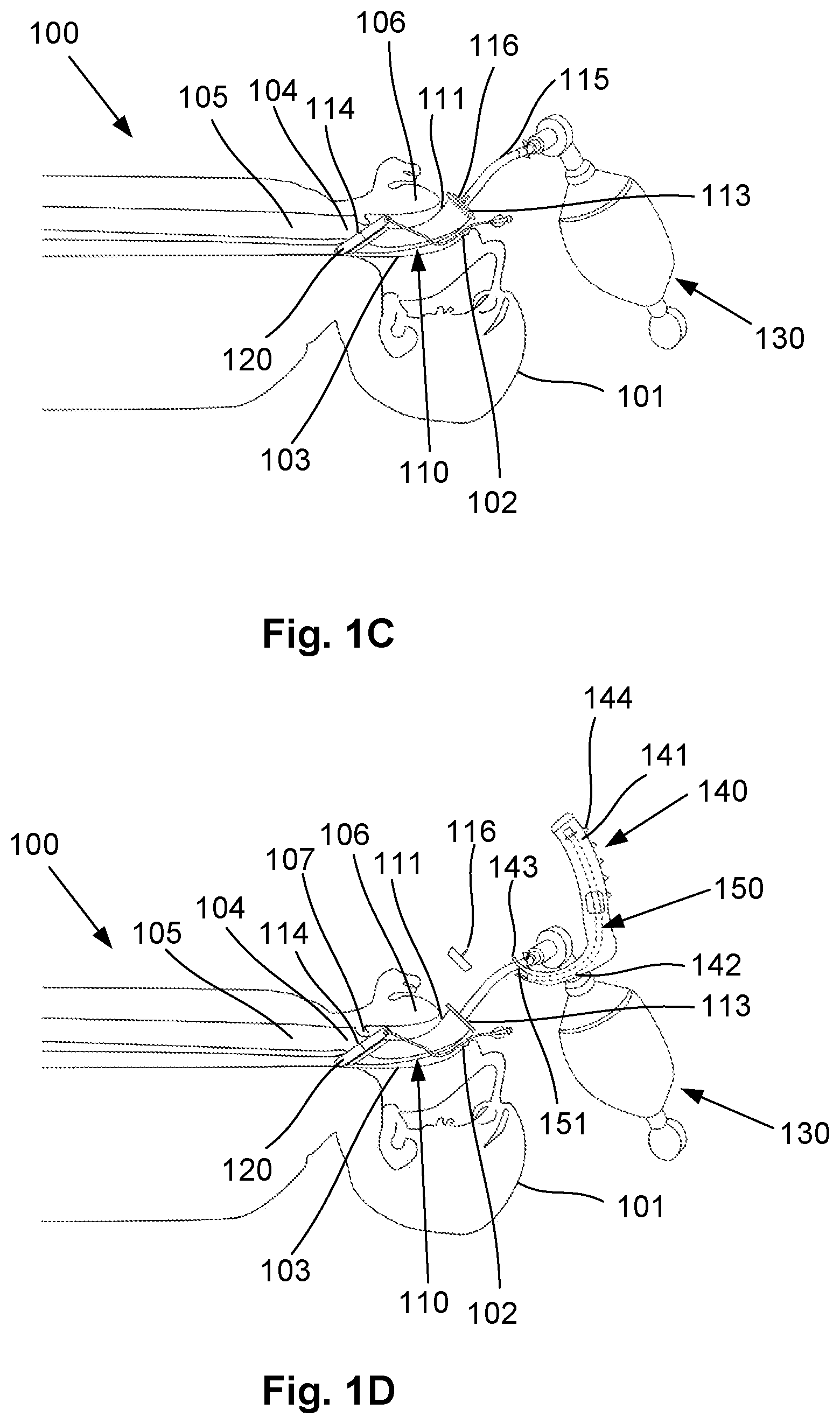 Patent US12564693 Figure 2 – Laryngeal mask airway intubation guide and method