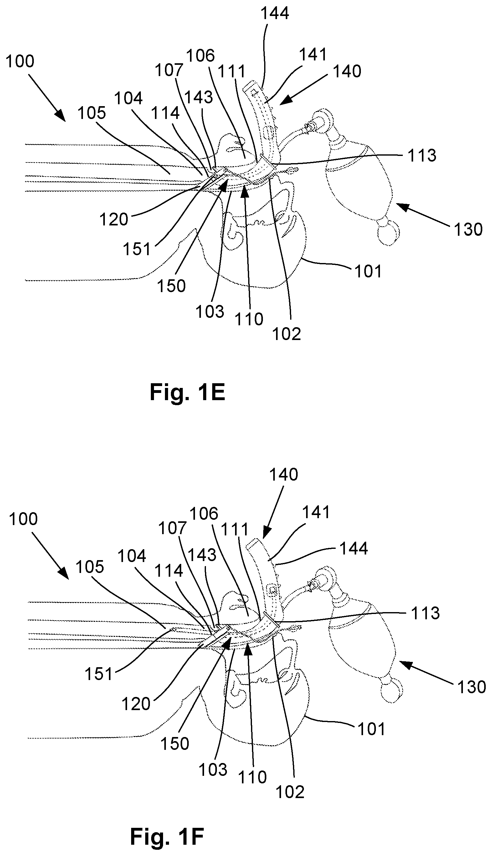 Patent US12564693 Figure 3 – Laryngeal mask airway intubation guide and method