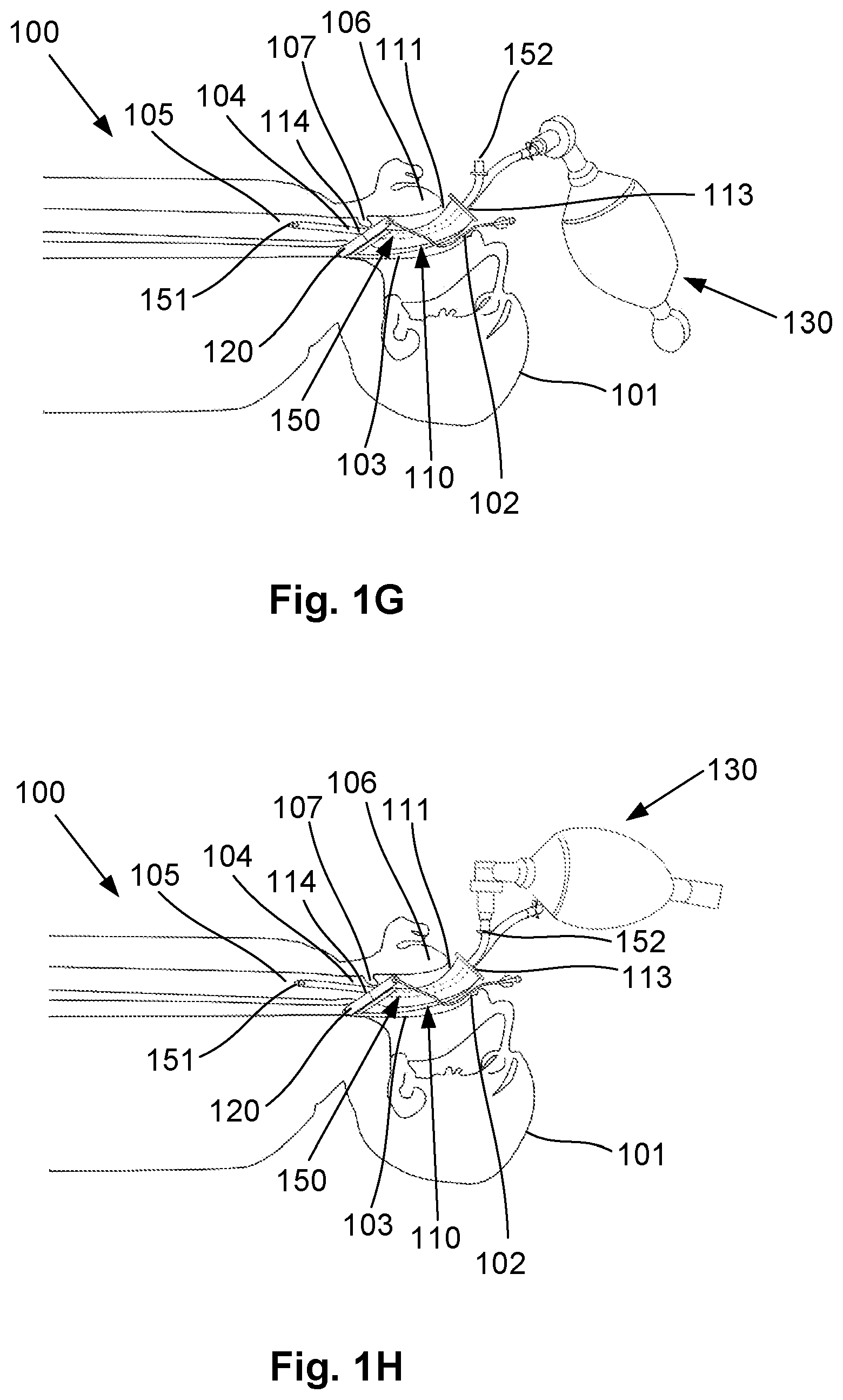 Patent US12564693 Figure 4 – Laryngeal mask airway intubation guide and method