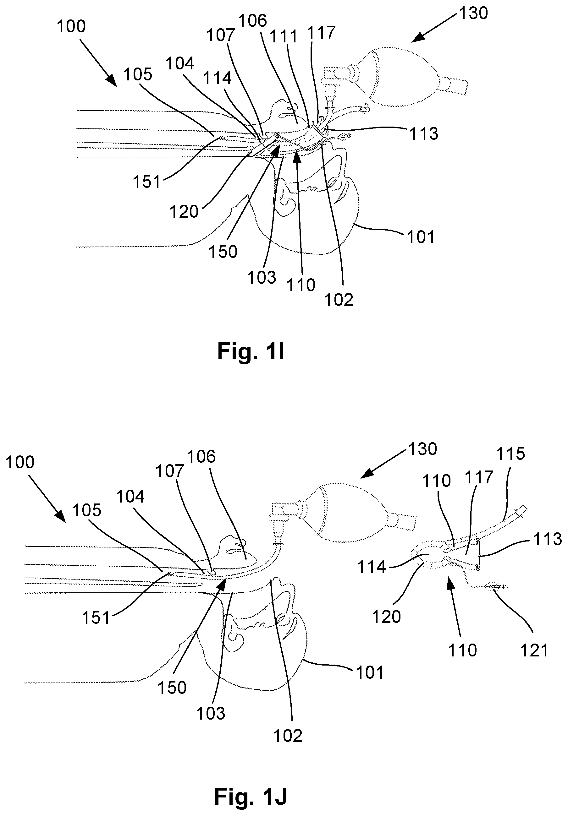Patent US12564693 Figure 5 – Laryngeal mask airway intubation guide and method